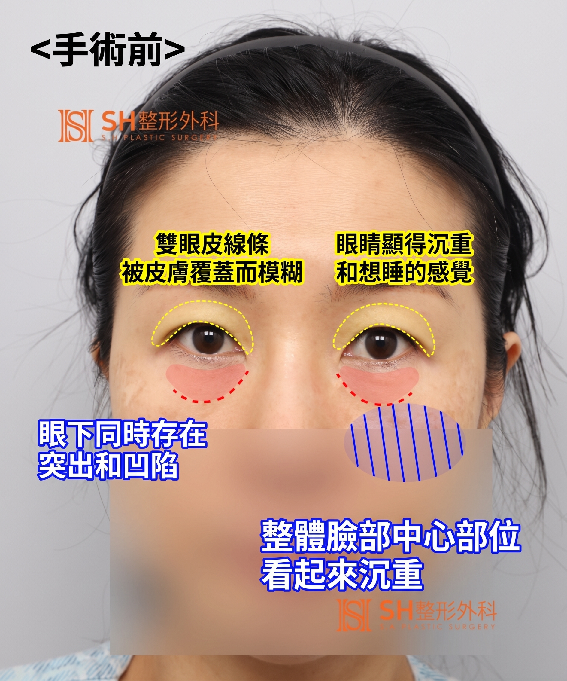 雙眼皮重修不如先做內視鏡提眉?|Endotine內視鏡提眉實際案例 SH整形外科 사진 4