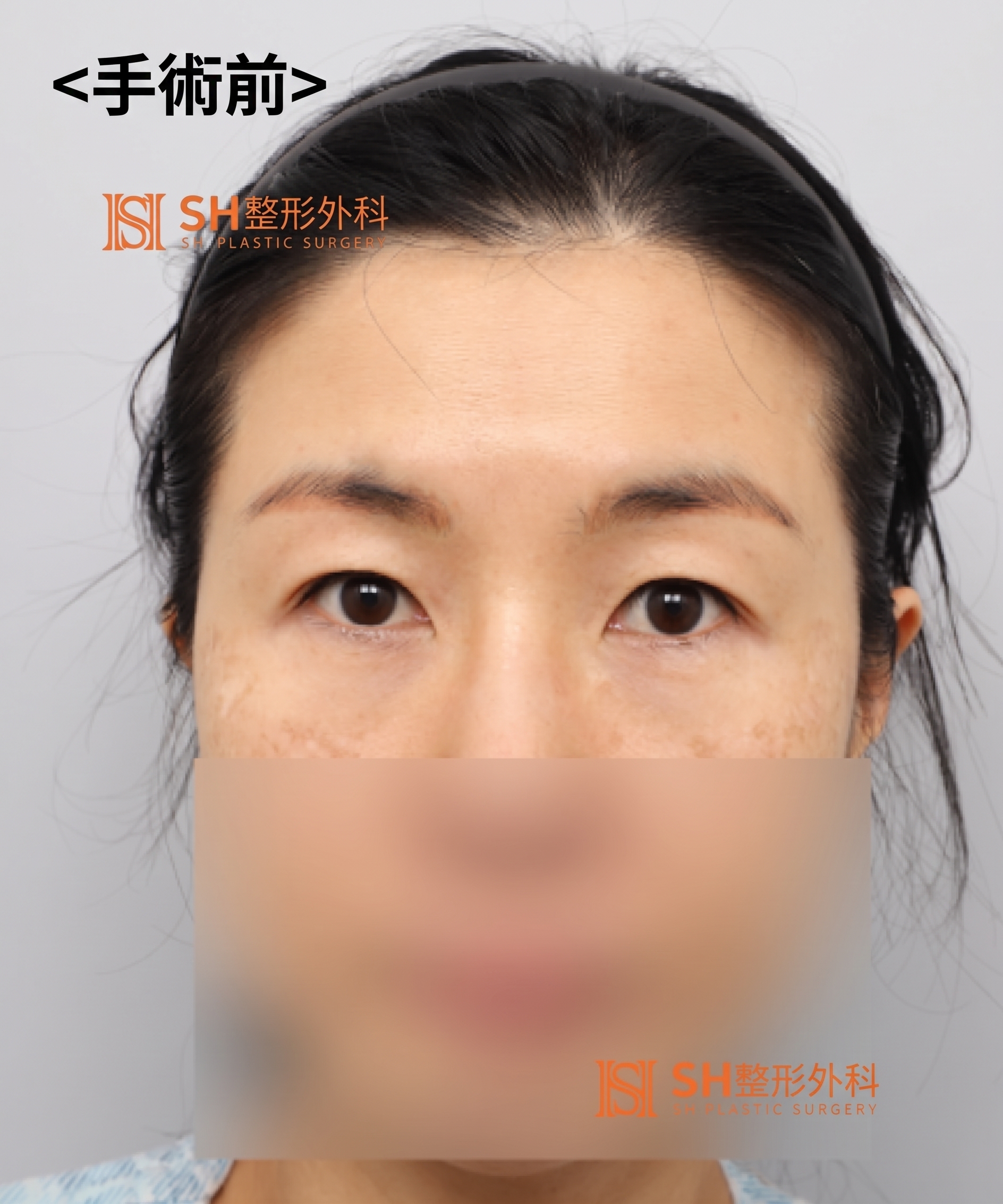 雙眼皮重修不如先做內視鏡提眉?|Endotine內視鏡提眉實際案例 SH整形外科