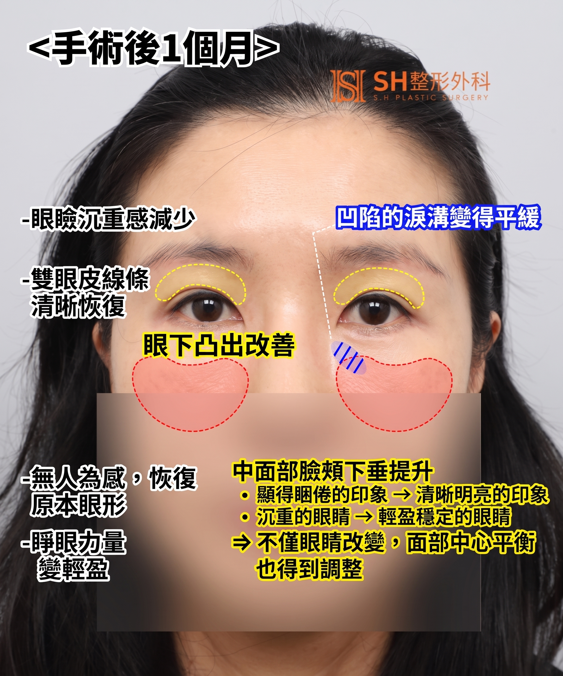 雙眼皮重修不如先做內視鏡提眉?|Endotine內視鏡提眉實際案例 SH整形外科 사진 6