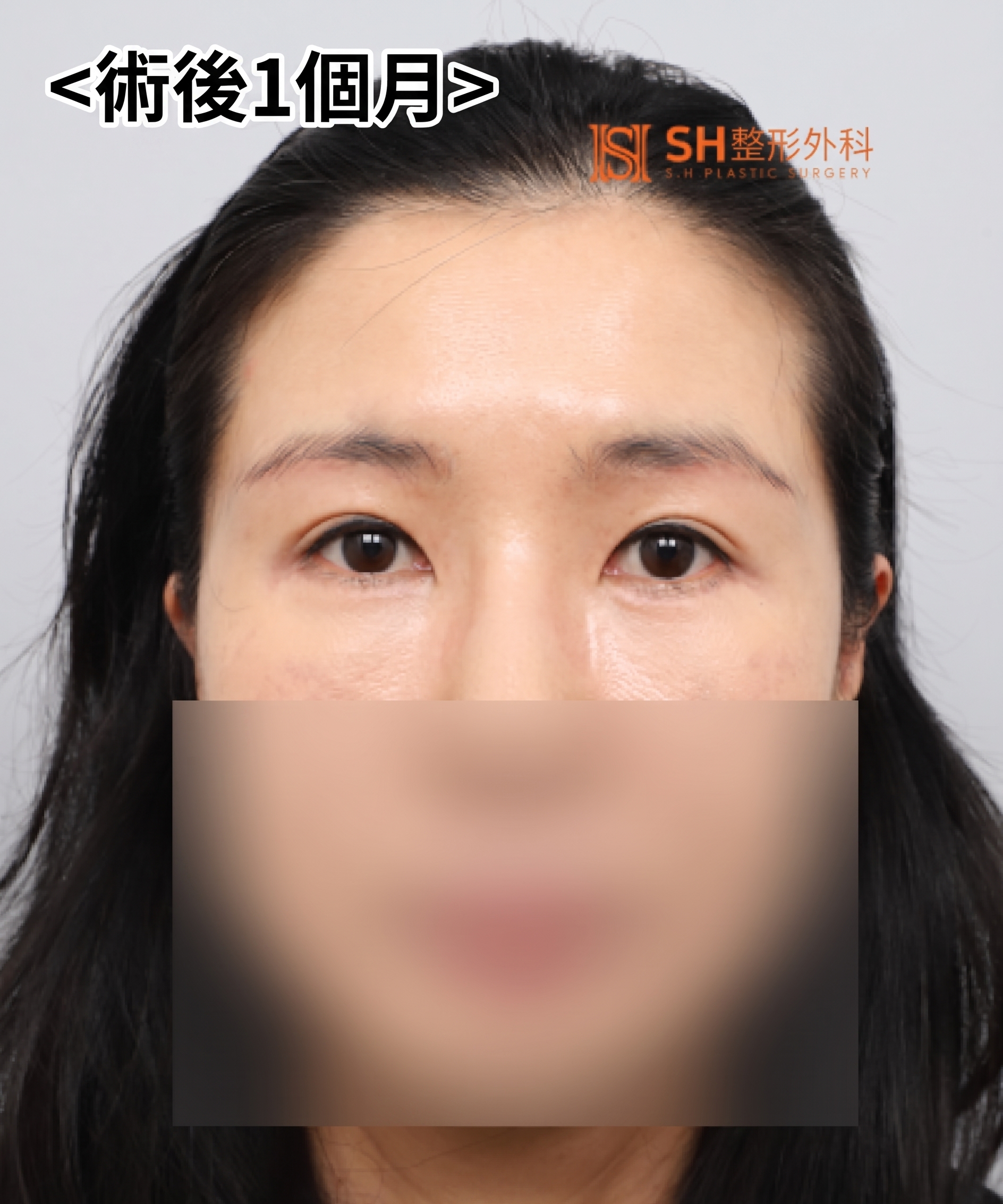 雙眼皮重修不如先做內視鏡提眉?|Endotine內視鏡提眉實際案例 SH整形外科 사진 16