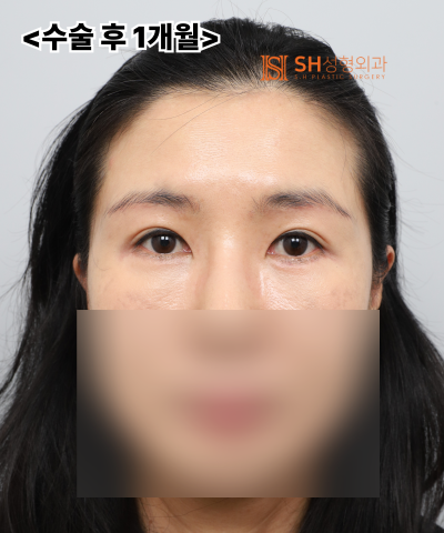 쌍꺼풀 재수술이 아닌 이마거상이 먼저였던 이유|엔도타인 내시경 이마거상 실제 사례 SH성형외과 에스에이치성형외과 사진 16