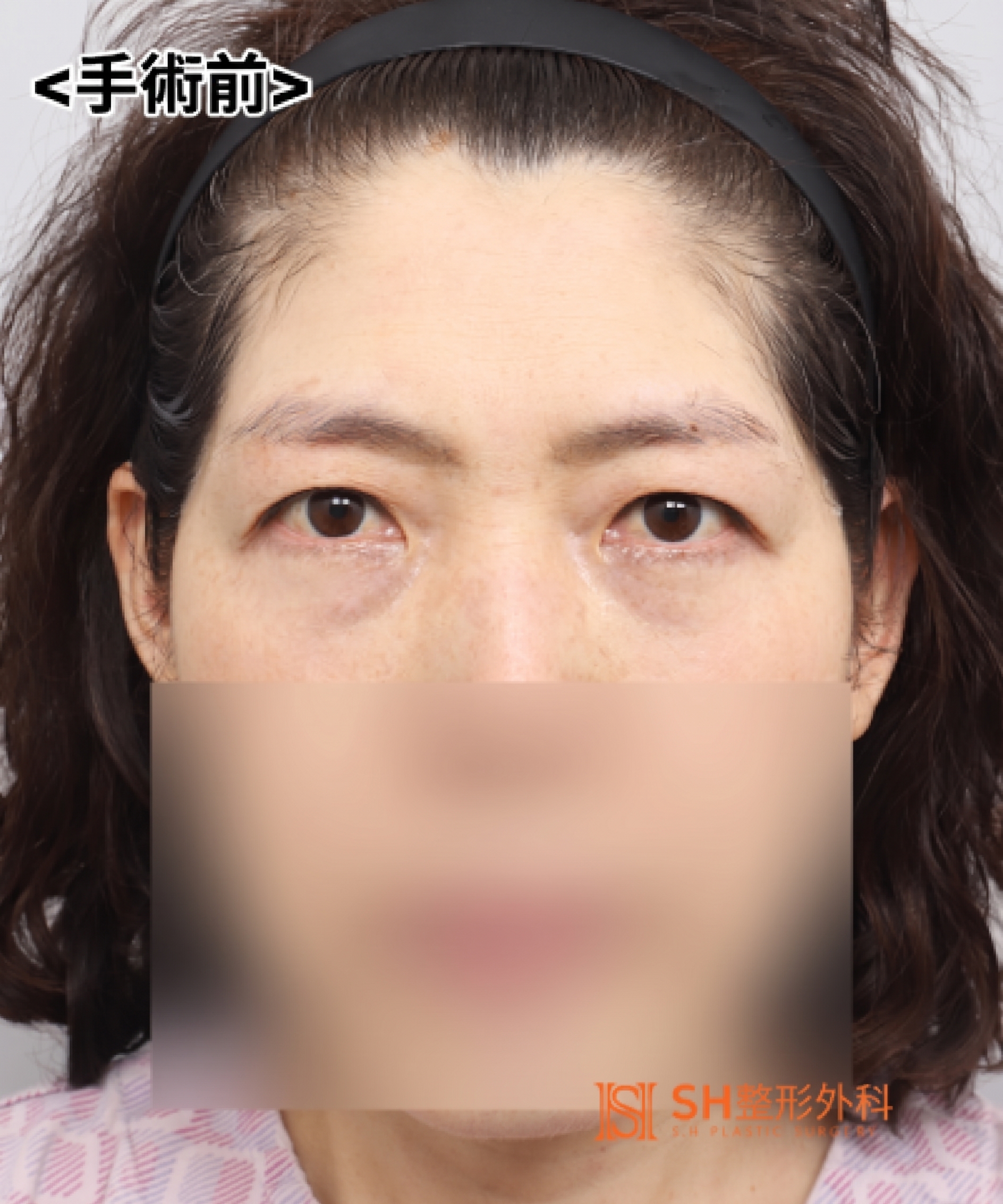 如果雙眼皮線條總是不穩定,原因可能是「額頭」。SH整形外科金成勳院長透過內視鏡額頭拉提術,改善上臉部下垂問題。 사진 11