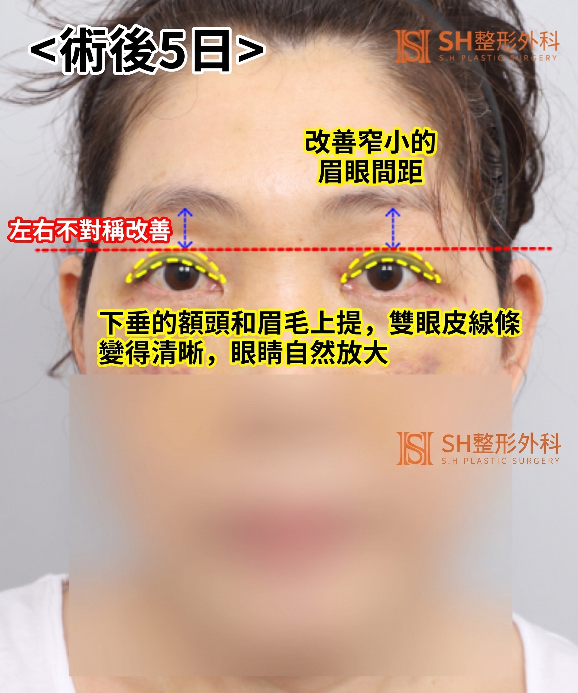 如果雙眼皮線條總是不穩定,原因可能是「額頭」。SH整形外科金成勳院長透過內視鏡額頭拉提術,改善上臉部下垂問題。 사진 15