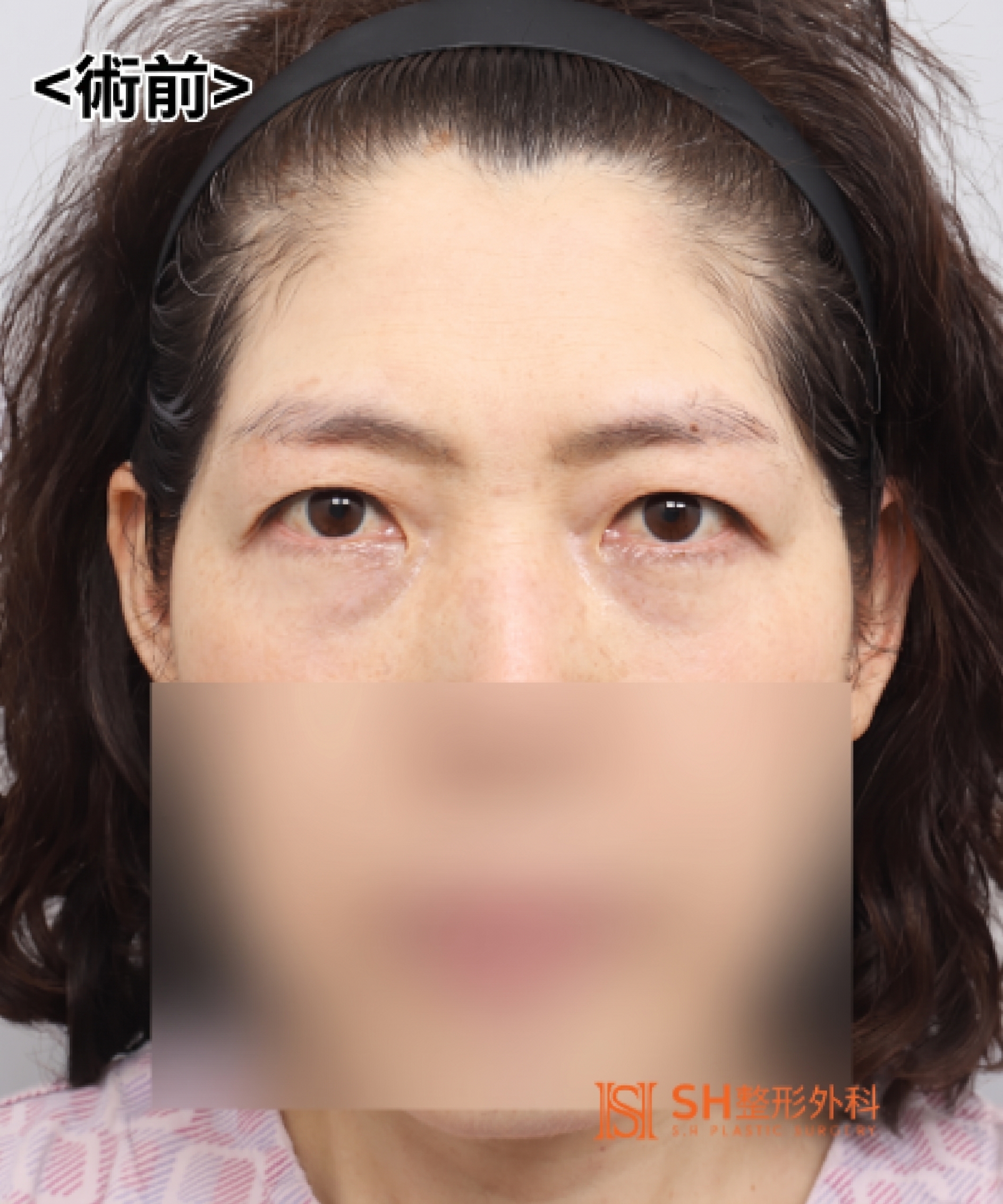 如果雙眼皮線條總是不穩定,原因可能是「額頭」。SH整形外科金成勳院長透過內視鏡額頭拉提術,改善上臉部下垂問題。 사진 18