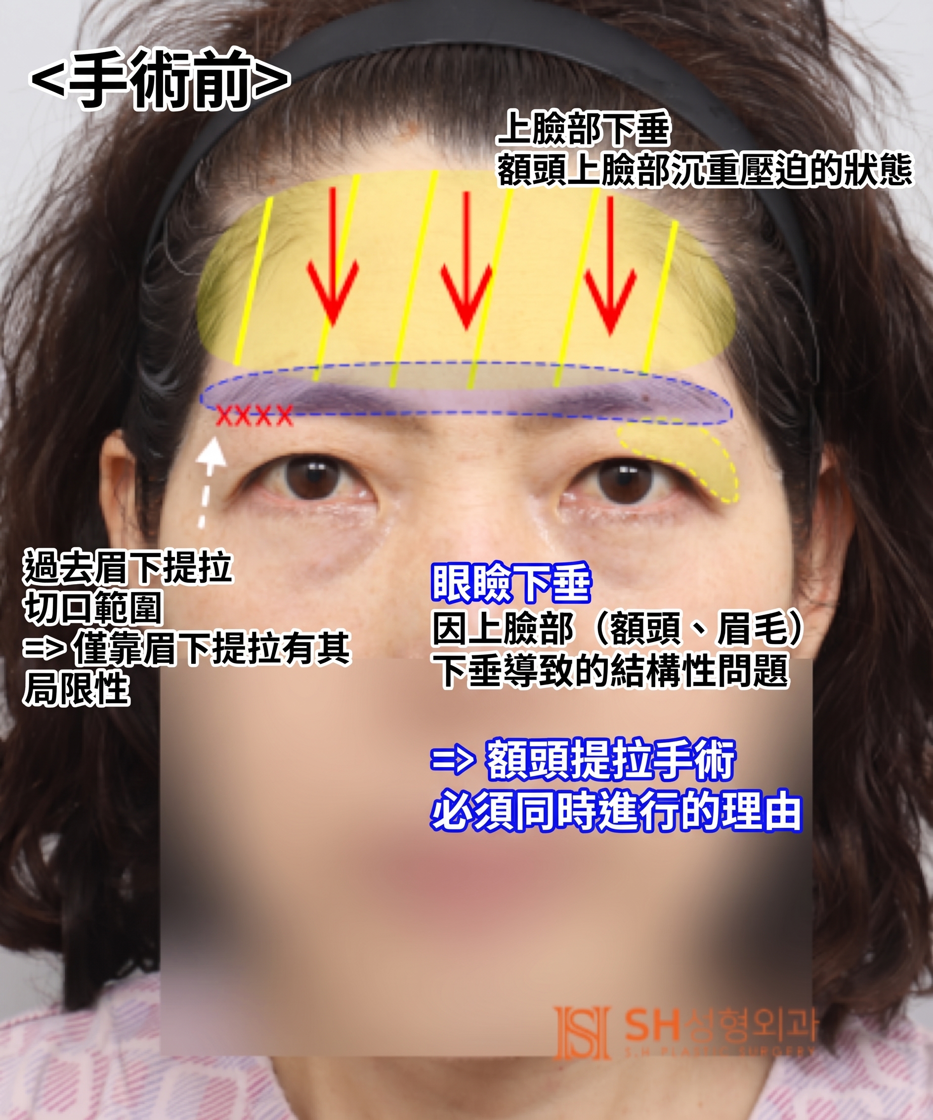 如果雙眼皮線條總是不穩定,原因可能是「額頭」。SH整形外科金成勳院長透過內視鏡額頭拉提術,改善上臉部下垂問題。 사진 16