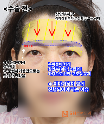 쌍꺼풀 라인이 자꾸 무너진다면, 원인은 ‘이마’일 수 있습니다. 엔도타인 내시경 이마거상으로 상안부까지 SH성형외과 에스에이치성형외과 사진 16