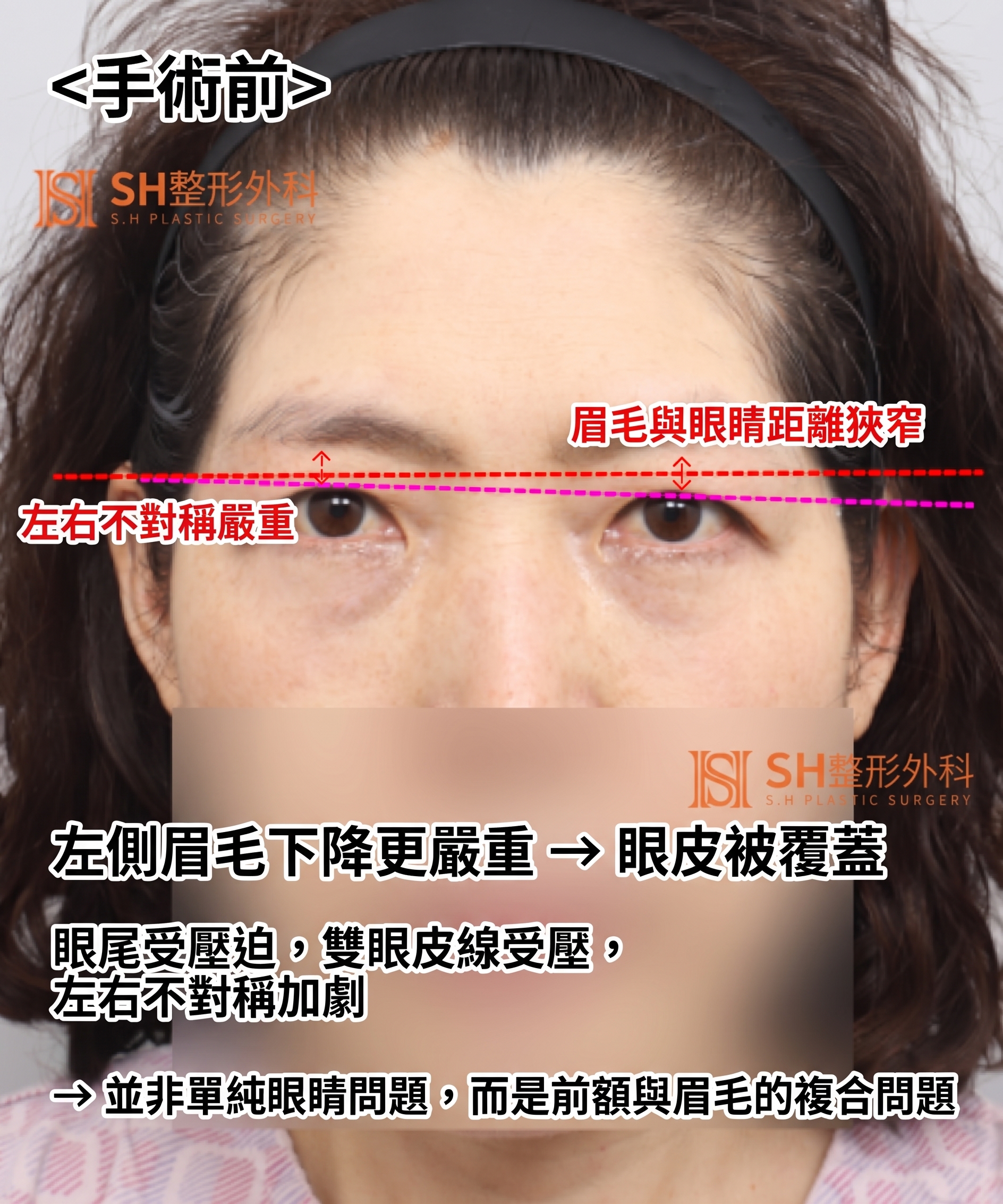 如果雙眼皮線條總是不穩定,原因可能是「額頭」。SH整形外科金成勳院長透過內視鏡額頭拉提術,改善上臉部下垂問題。 사진 14