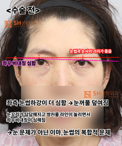 쌍꺼풀 라인이 자꾸 무너진다면, 원인은 ‘이마’일 수 있습니다. 엔도타인 내시경 이마거상으로 상안부까지 SH성형외과 에스에이치성형외과 사진 14