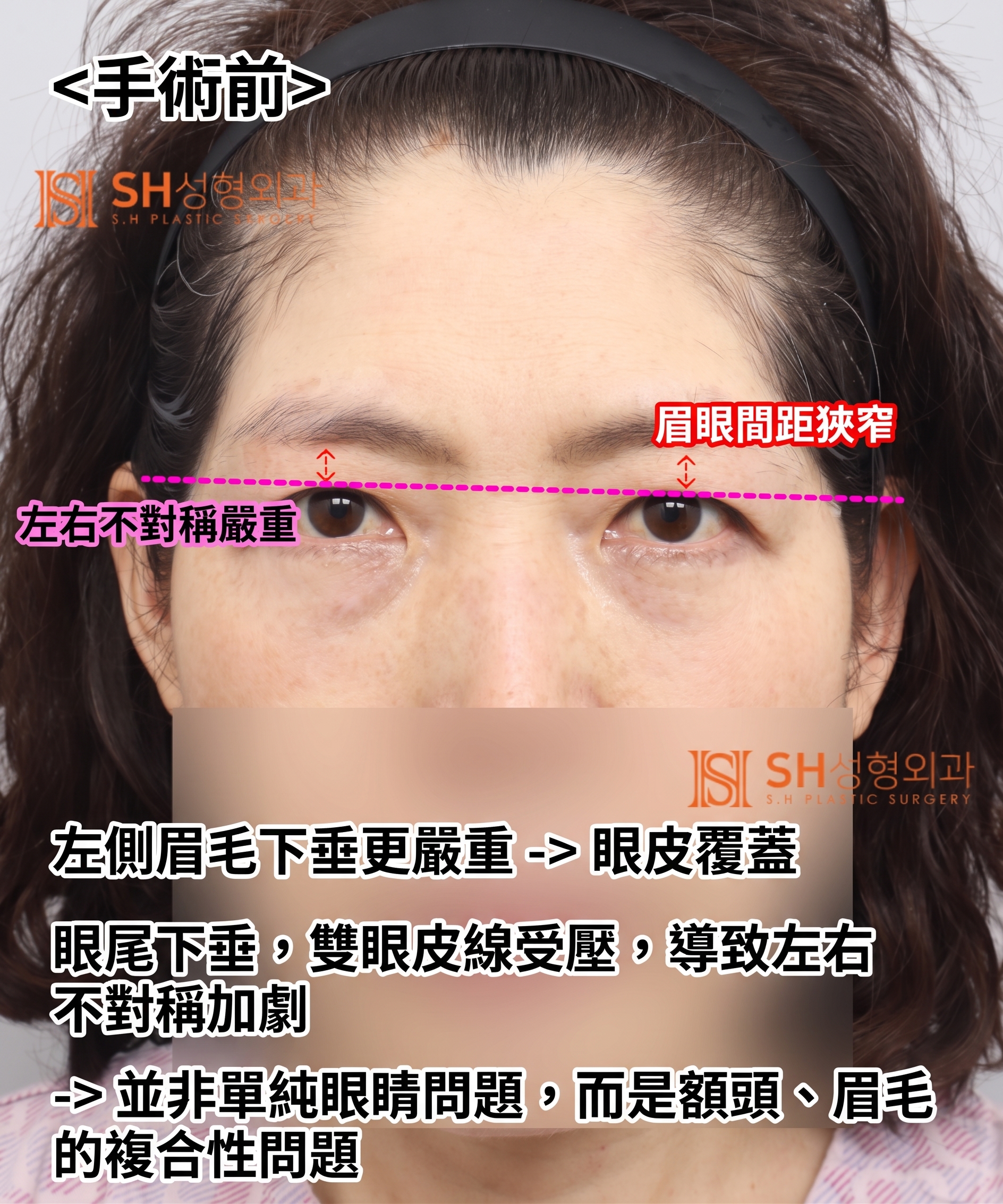 如果雙眼皮線條總是不穩定,原因可能是「額頭」。SH整形外科金成勳院長透過內視鏡額頭拉提術,改善上臉部下垂問題。 사진 4