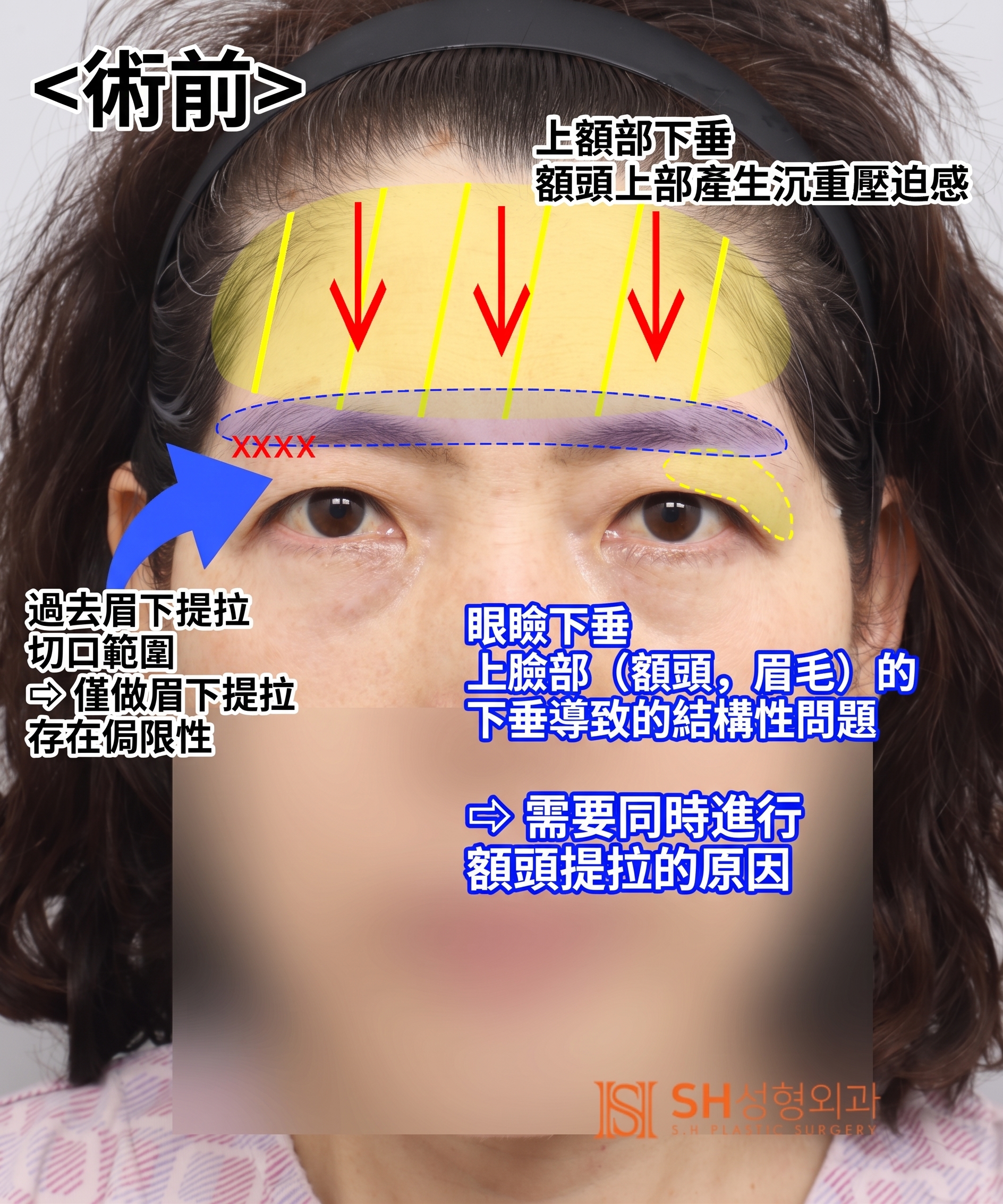 如果雙眼皮線條總是不穩定,原因可能是「額頭」。SH整形外科金成勳院長透過內視鏡額頭拉提術,改善上臉部下垂問題。 사진 3