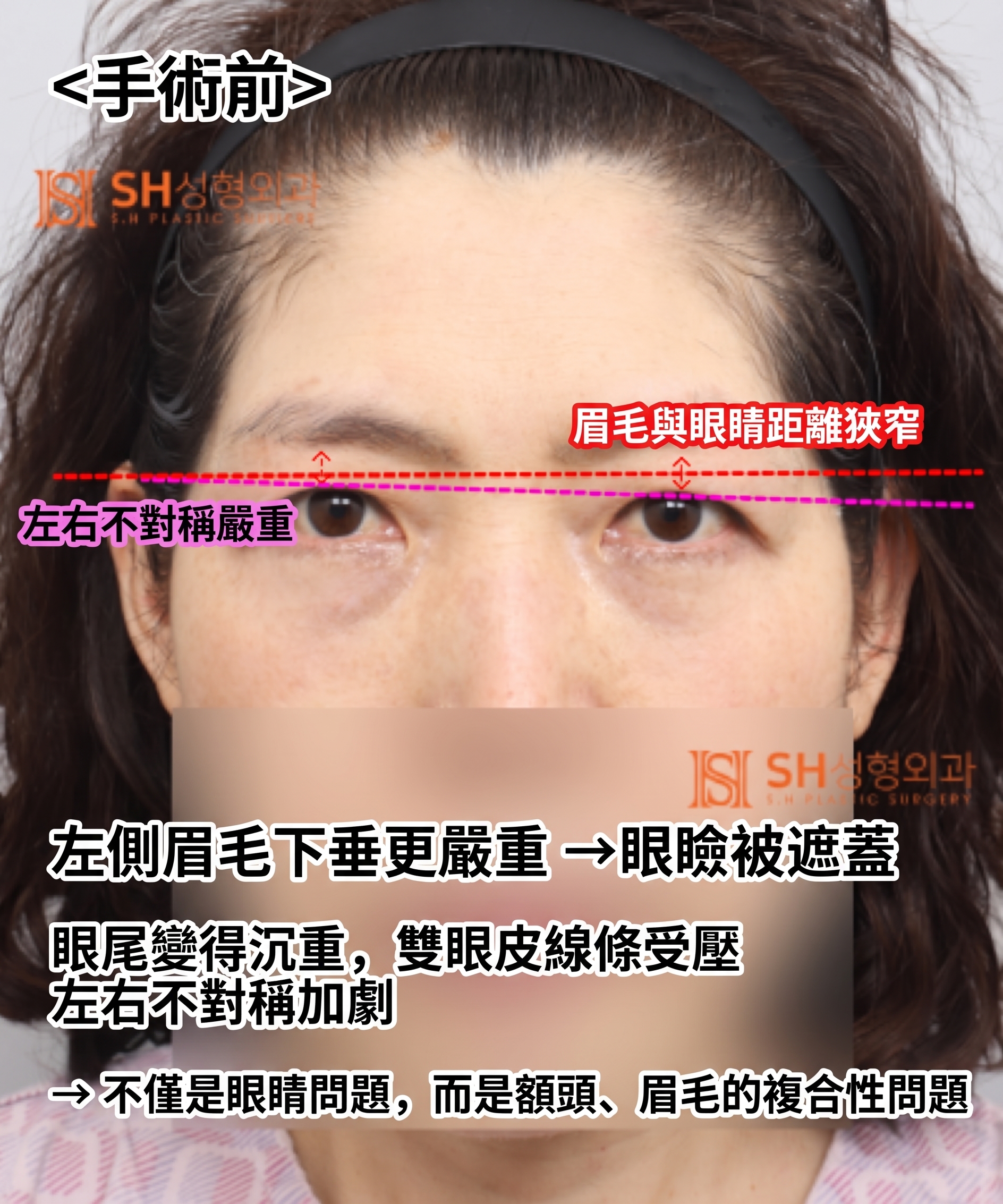如果雙眼皮線條總是不穩定,原因可能是「額頭」。SH整形外科金成勳院長透過內視鏡額頭拉提術,改善上臉部下垂問題。 사진 6