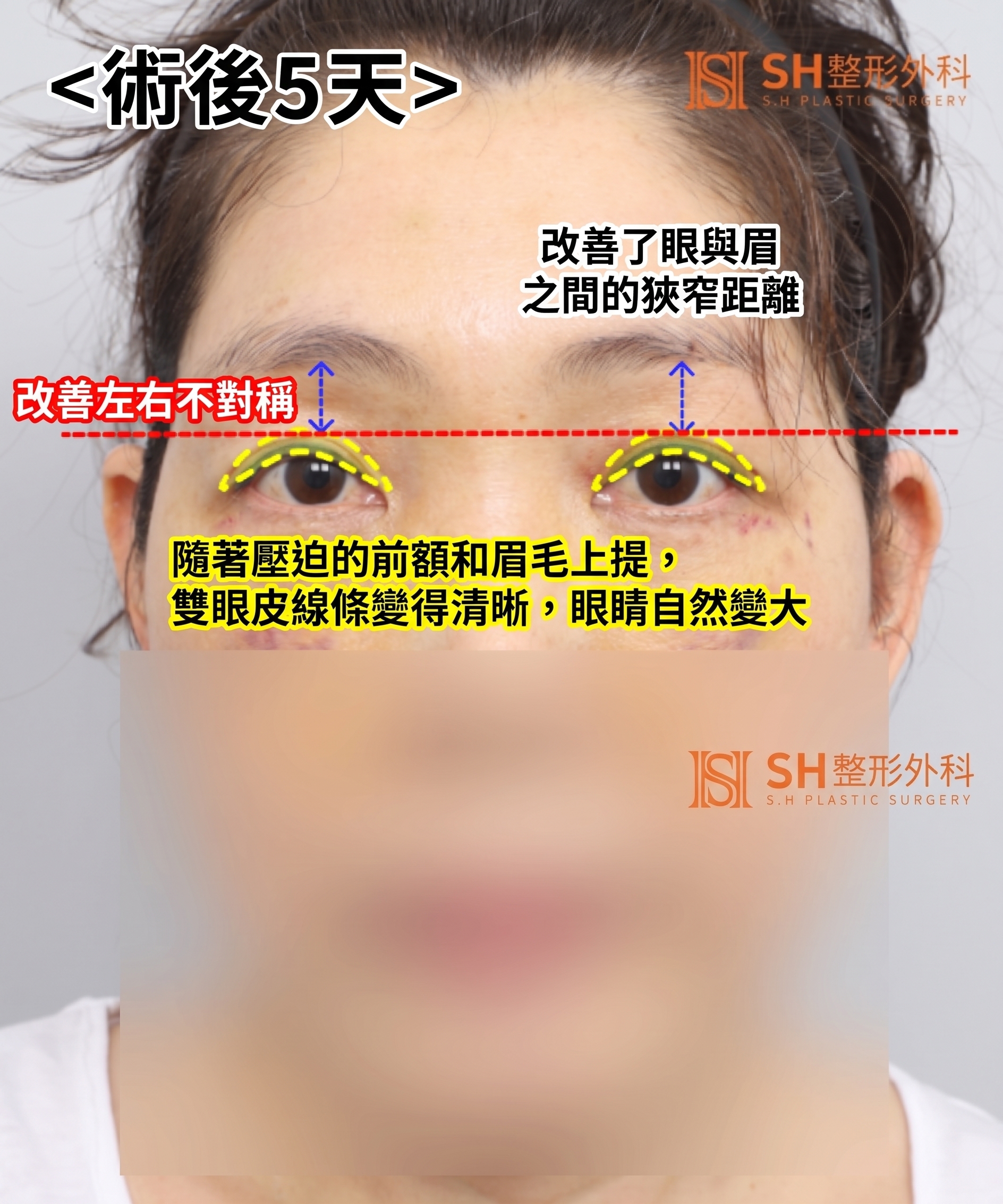 如果雙眼皮線條總是不穩定,原因可能是「額頭」。SH整形外科金成勳院長透過內視鏡額頭拉提術,改善上臉部下垂問題。 사진 7