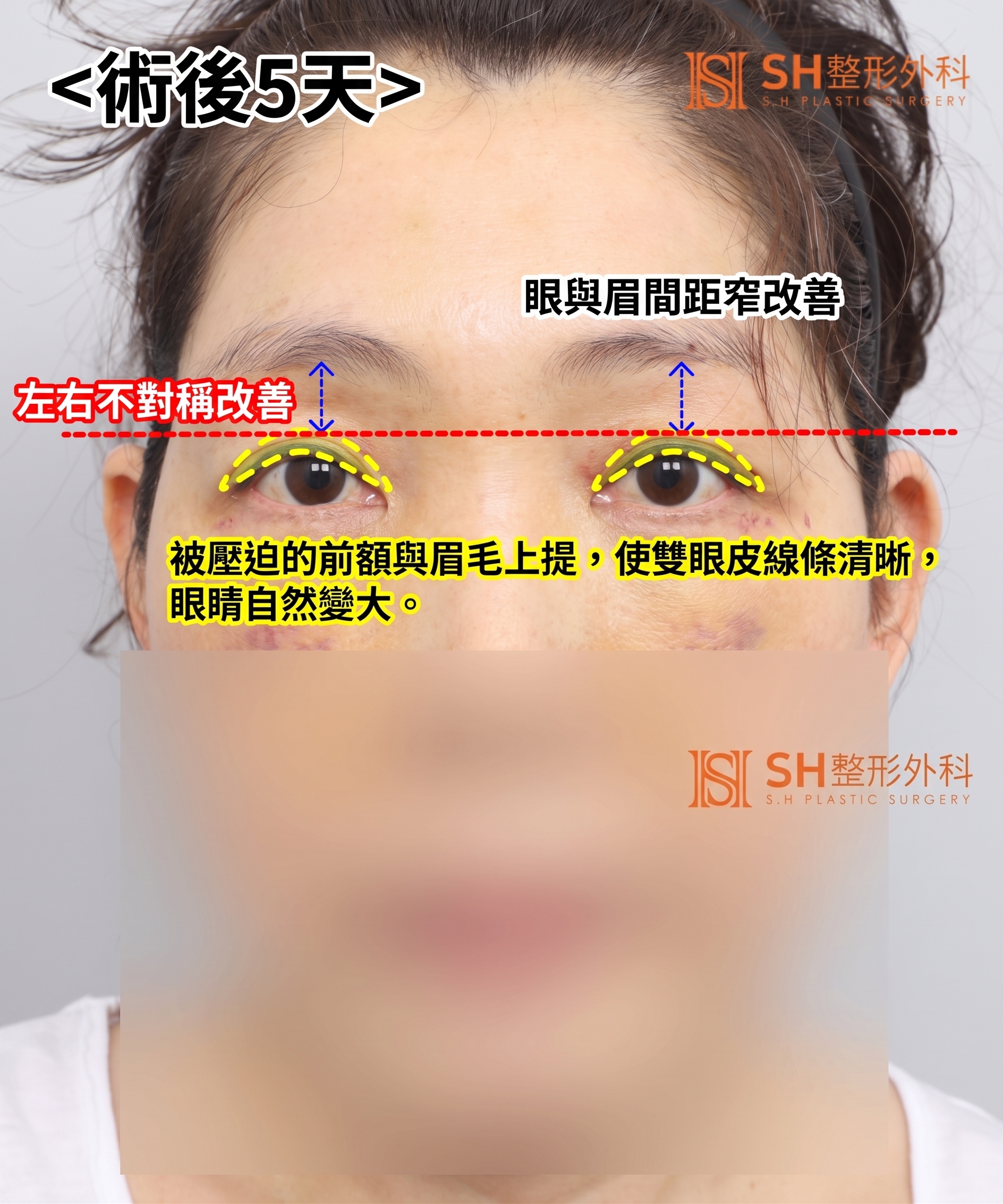 如果雙眼皮線條總是不穩定,原因可能是「額頭」。SH整形外科金成勳院長透過內視鏡額頭拉提術,改善上臉部下垂問題。 사진 5