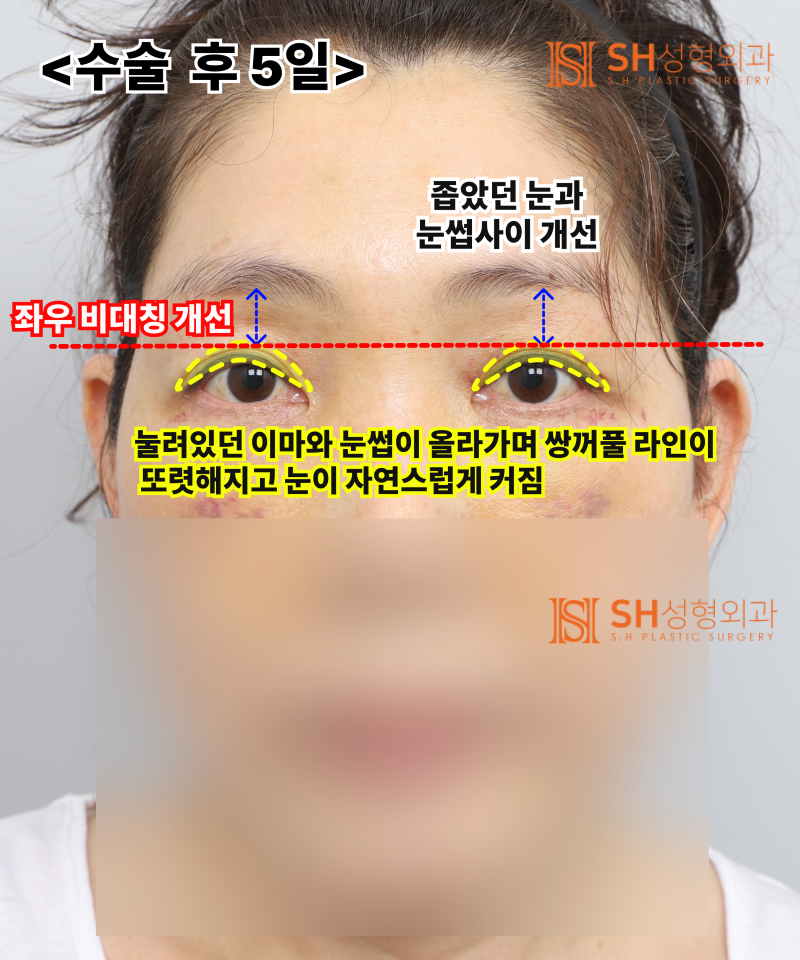 쌍꺼풀 라인이 자꾸 무너진다면, 원인은 ‘이마’일 수 있습니다. 엔도타인 내시경 이마거상으로 상안부까지 SH성형외과 에스에이치성형외과 사진 5