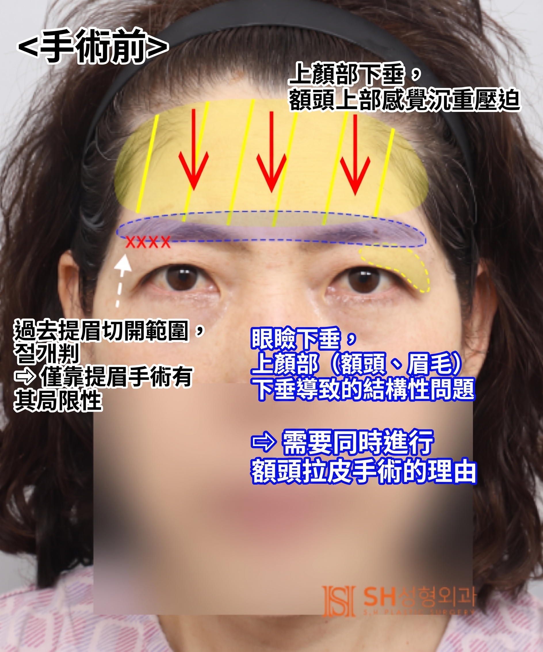 如果雙眼皮線條總是不穩定,原因可能是「額頭」。SH整形外科金成勳院長透過內視鏡額頭拉提術,改善上臉部下垂問題。 사진 9
