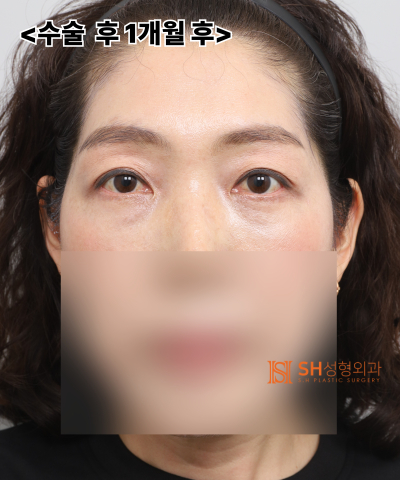 쌍꺼풀 라인이 자꾸 무너진다면, 원인은 ‘이마’일 수 있습니다. 엔도타인 내시경 이마거상으로 상안부까지 SH성형외과 에스에이치성형외과 사진 12