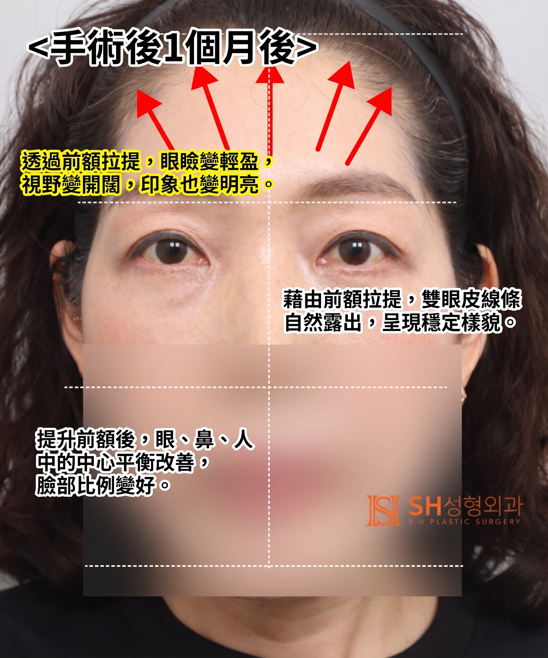 如果雙眼皮線條總是不穩定,原因可能是「額頭」。SH整形外科金成勳院長透過內視鏡額頭拉提術,改善上臉部下垂問題。 사진 10