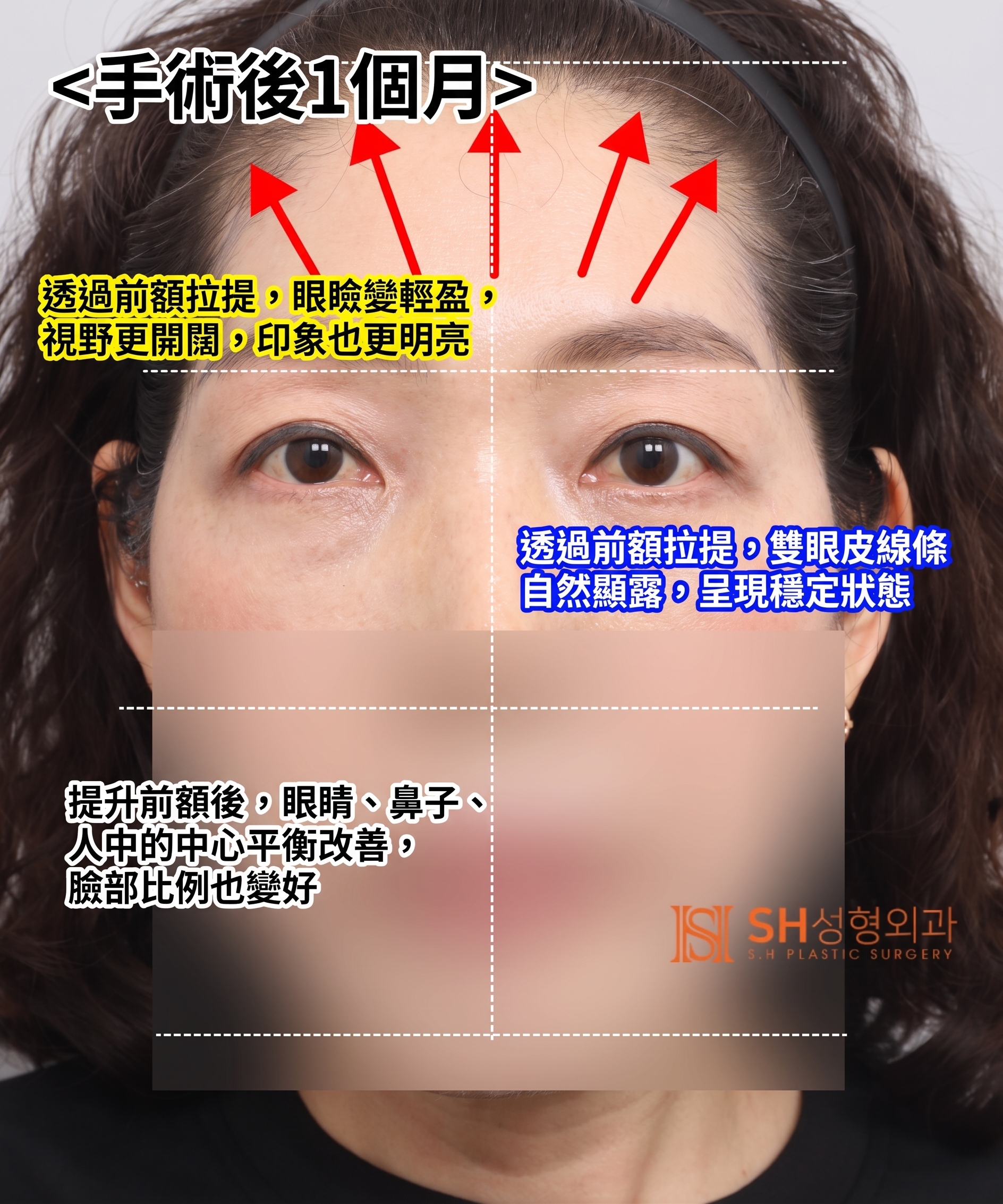 如果雙眼皮線條總是不穩定,原因可能是「額頭」。SH整形外科金成勳院長透過內視鏡額頭拉提術,改善上臉部下垂問題。 사진 8