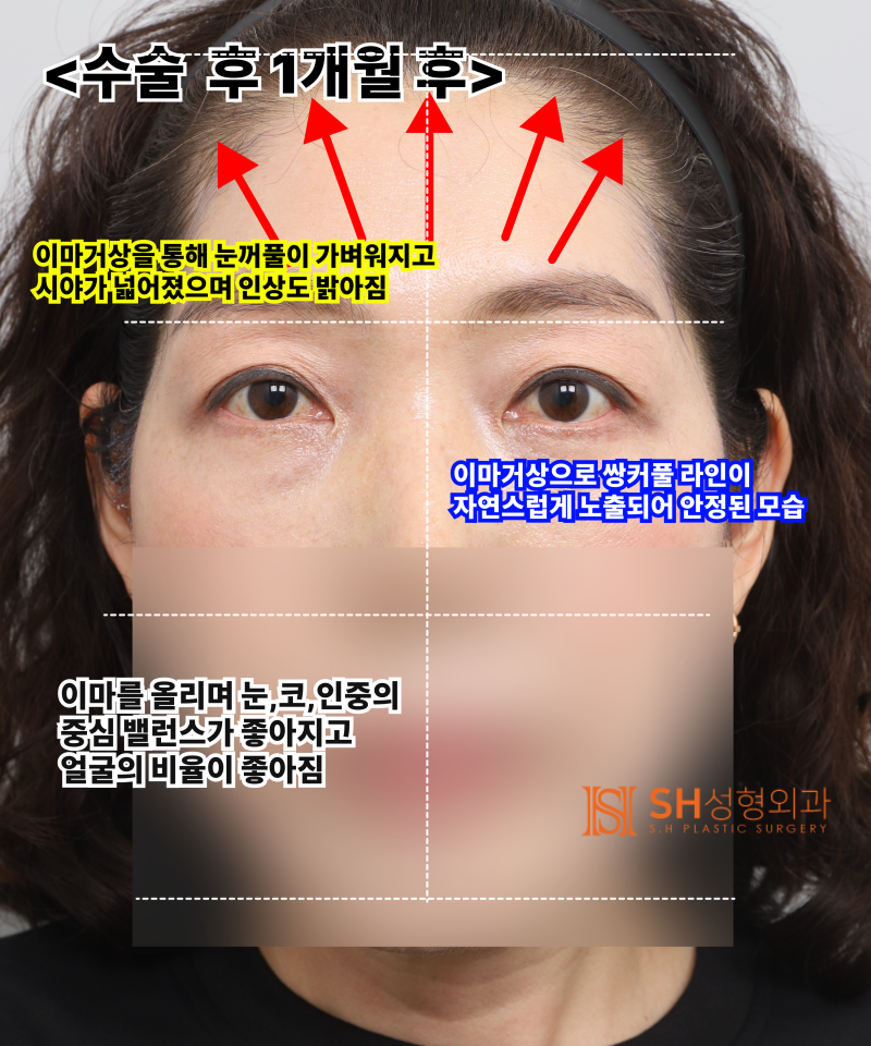 쌍꺼풀 라인이 자꾸 무너진다면, 원인은 ‘이마’일 수 있습니다. 엔도타인 내시경 이마거상으로 상안부까지 SH성형외과 에스에이치성형외과 사진 8
