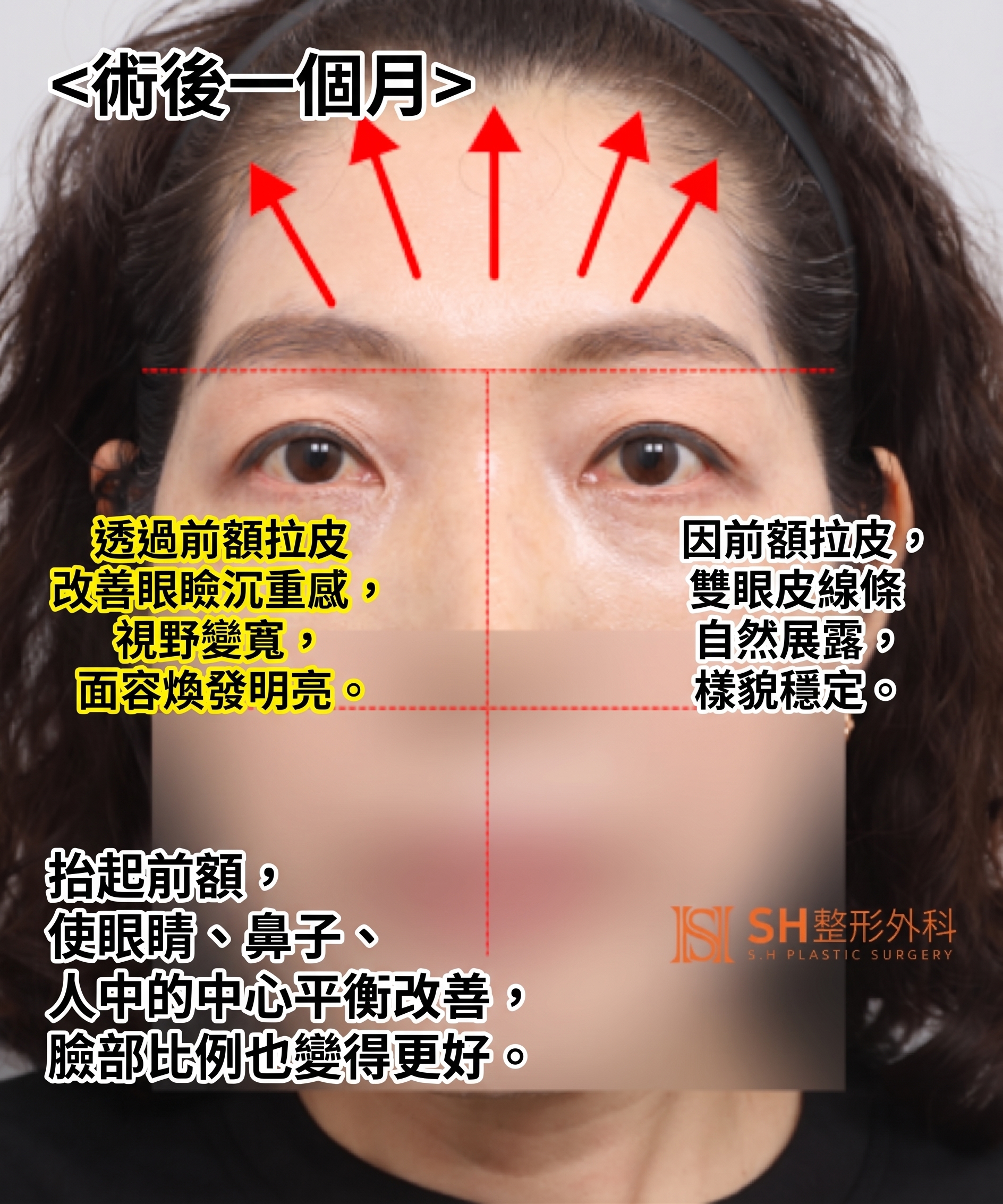 如果雙眼皮線條總是不穩定,原因可能是「額頭」。SH整形外科金成勳院長透過內視鏡額頭拉提術,改善上臉部下垂問題。 사진 17