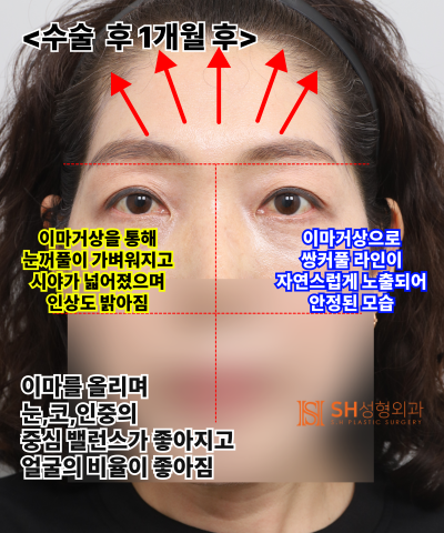 쌍꺼풀 라인이 자꾸 무너진다면, 원인은 ‘이마’일 수 있습니다. 엔도타인 내시경 이마거상으로 상안부까지 SH성형외과 에스에이치성형외과 사진 17