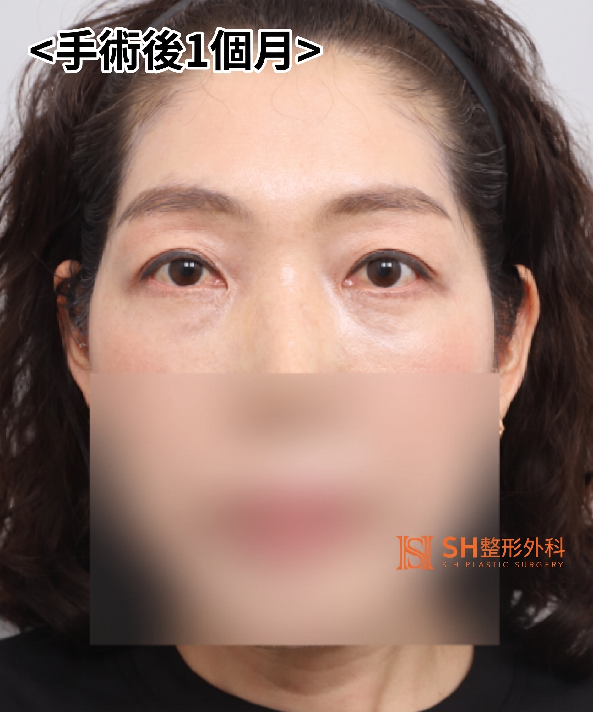 如果雙眼皮線條總是不穩定,原因可能是「額頭」。SH整形外科金成勳院長透過內視鏡額頭拉提術,改善上臉部下垂問題。 사진 2