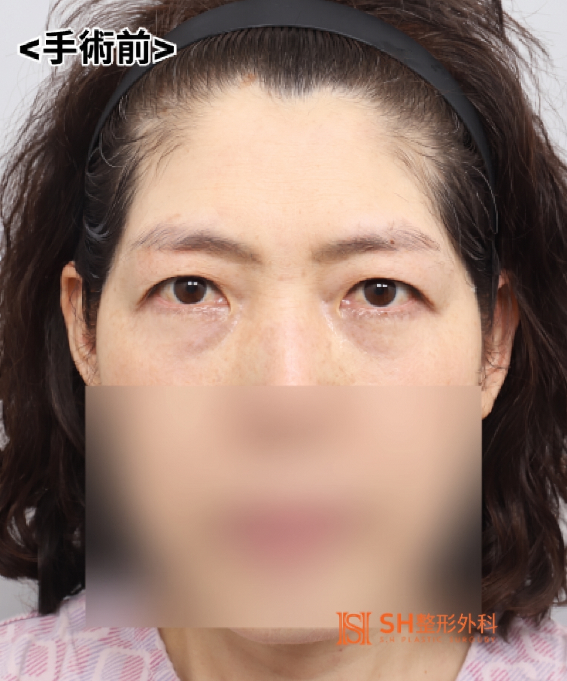 如果雙眼皮線條總是不穩定,原因可能是「額頭」。SH整形外科金成勳院長透過內視鏡額頭拉提術,改善上臉部下垂問題。
