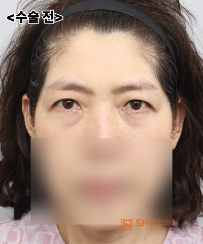 쌍꺼풀 라인이 자꾸 무너진다면, 원인은 ‘이마’일 수 있습니다. 엔도타인 내시경 이마거상으로 상안부까지 SH성형외과 에스에이치성형외과