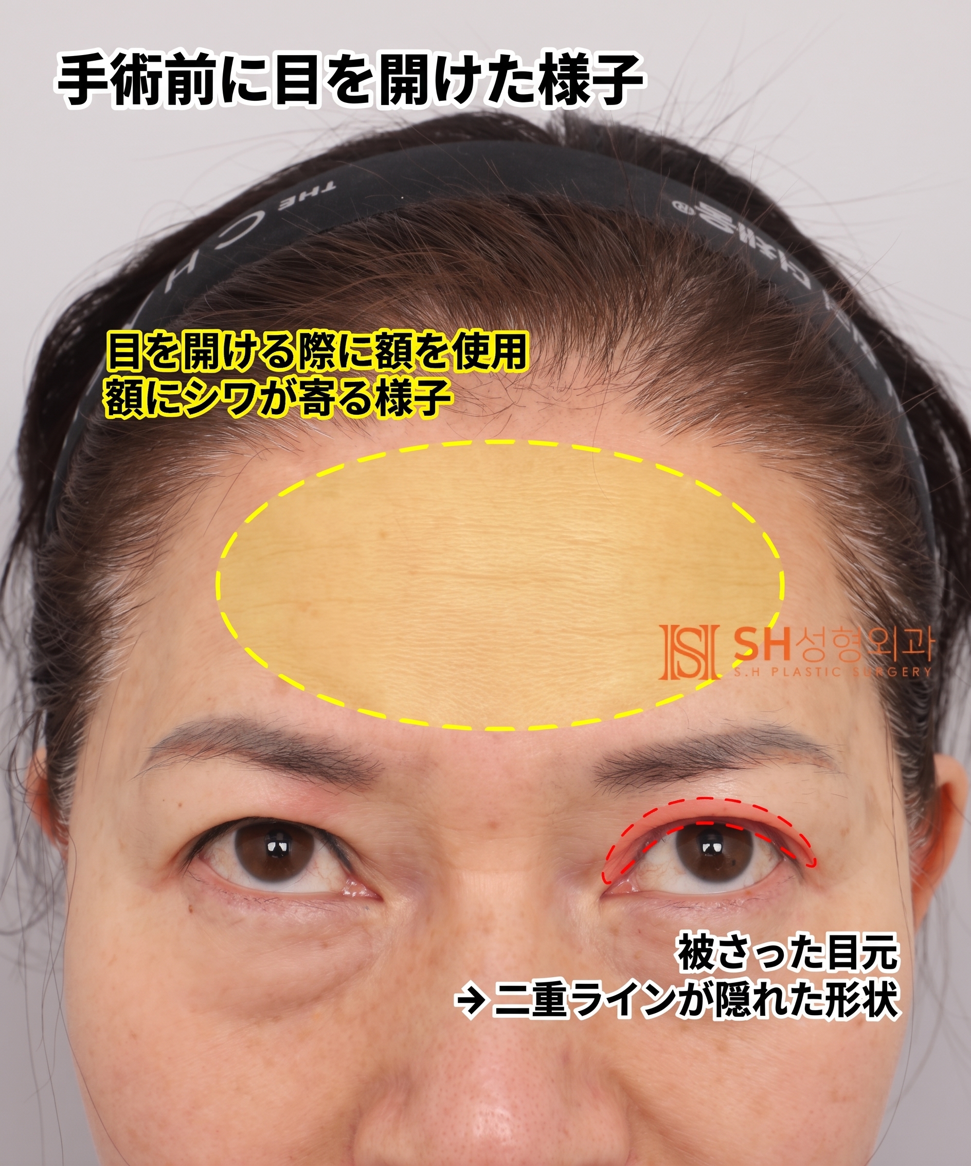 51歳目のたるみ、切開二重ではなくエンドタイン額挙上で解決した理由 | 眉下切開・下眼瞼複合手術ケース SH美容外科 エスエイチ美容外科 사진 5