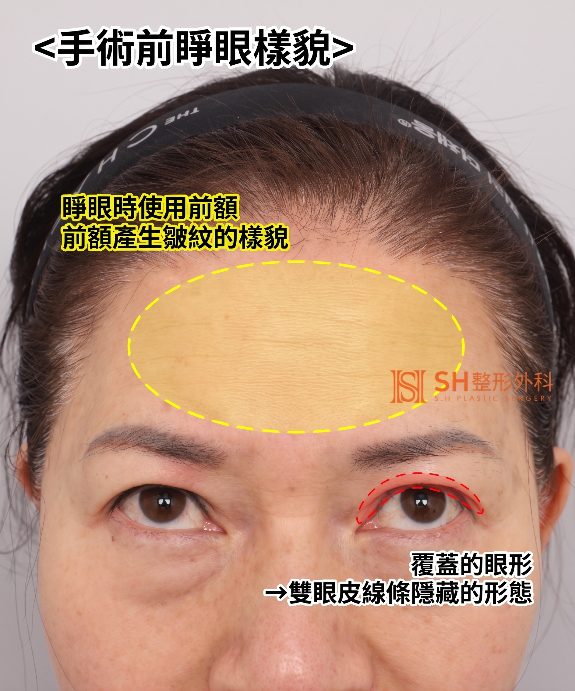 51歲眼皮下垂,為何選擇內視鏡五爪釘提眉術而非切開式雙眼皮? | 眉下提拉·下眼瞼複合手術案例 SH整形外科 사진 5