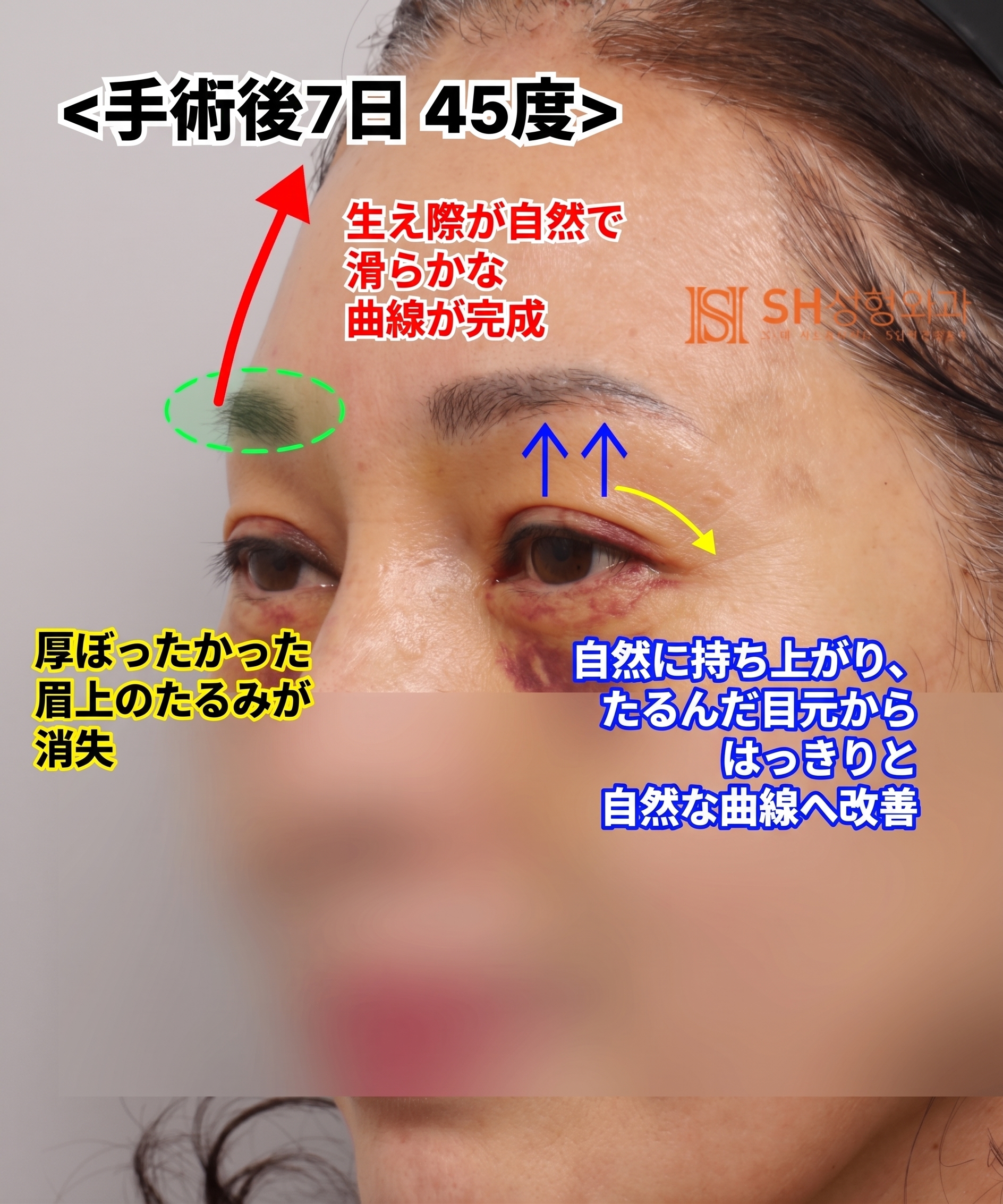51歳目のたるみ、切開二重ではなくエンドタイン額挙上で解決した理由 | 眉下切開・下眼瞼複合手術ケース SH美容外科 エスエイチ美容外科 사진 7