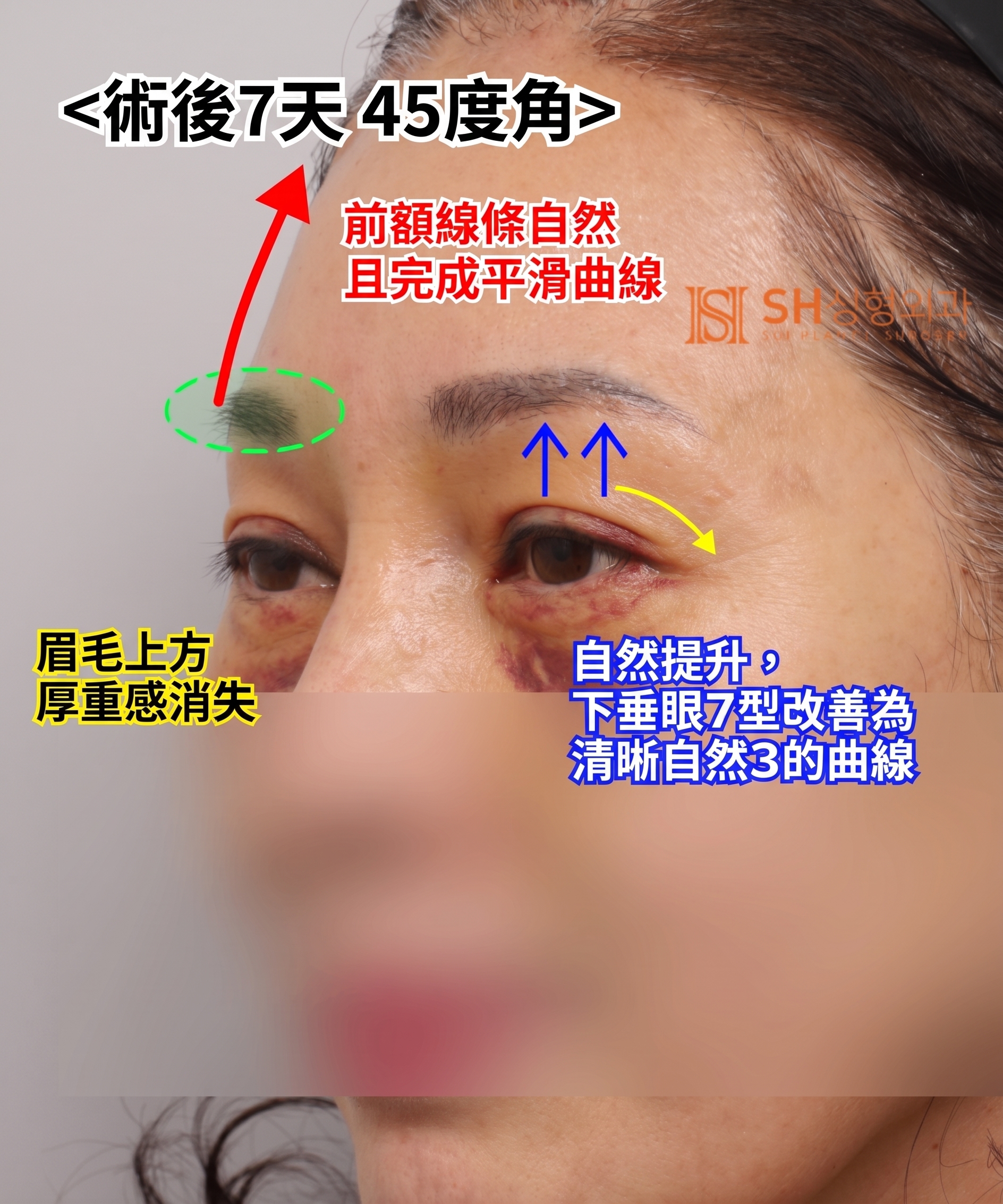 51歲眼皮下垂,為何選擇內視鏡五爪釘提眉術而非切開式雙眼皮? | 眉下提拉·下眼瞼複合手術案例 SH整形外科 사진 7