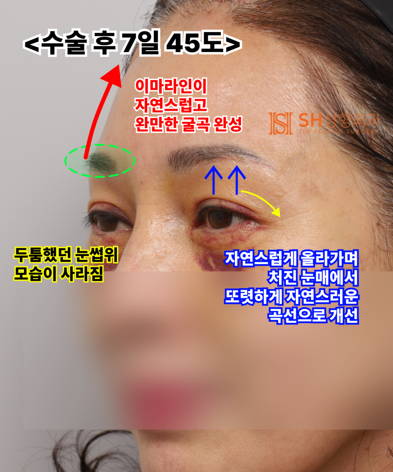 51세 눈처짐, 절개쌍꺼풀 대신 엔도타인 이마거상으로 해결한 이유 | 눈썹하거상·하안검 복합수술 케이스 SH성형외과 에스에이치성형외과 사진 7