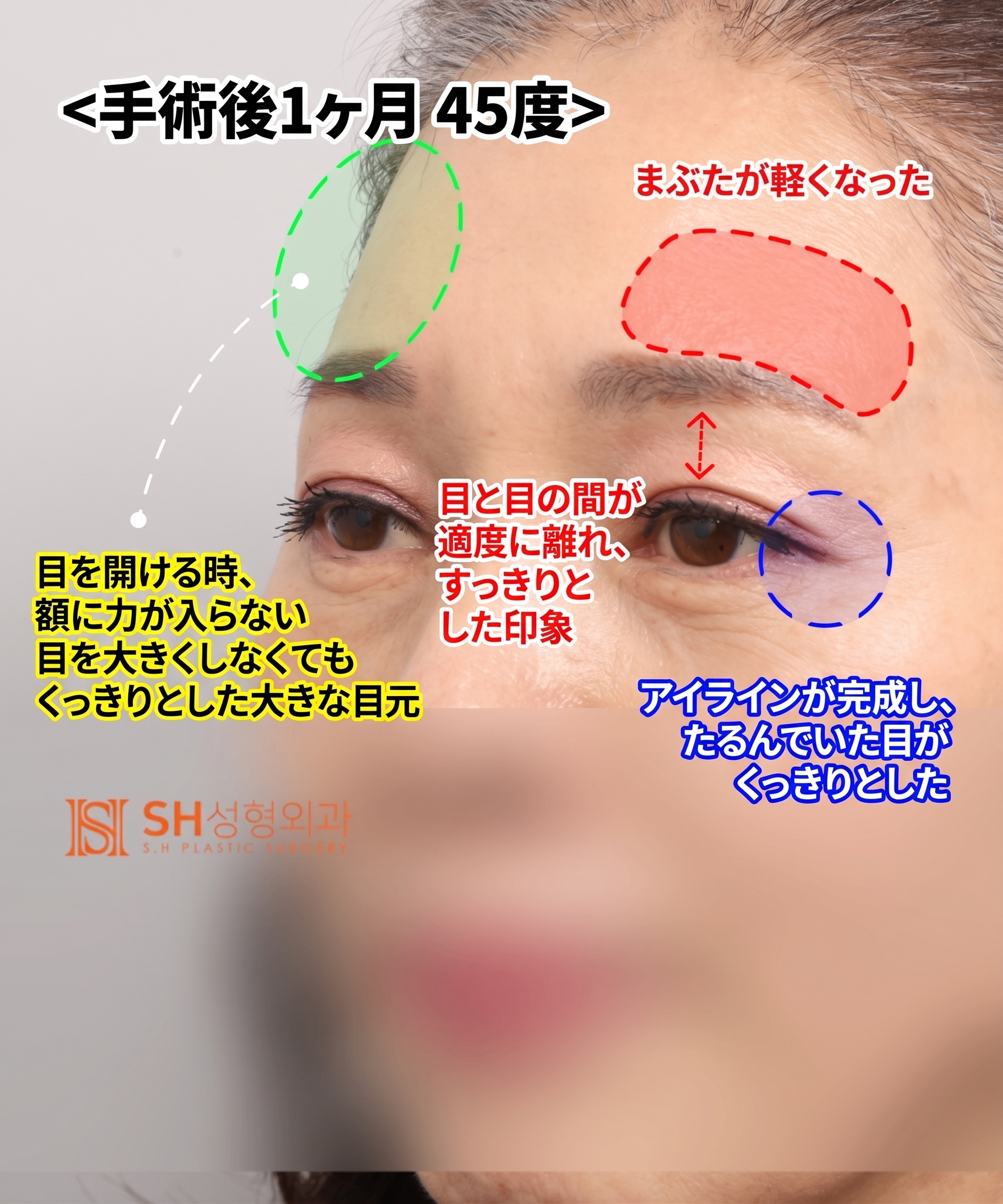51歳目のたるみ、切開二重ではなくエンドタイン額挙上で解決した理由 | 眉下切開・下眼瞼複合手術ケース SH美容外科 エスエイチ美容外科 사진 9