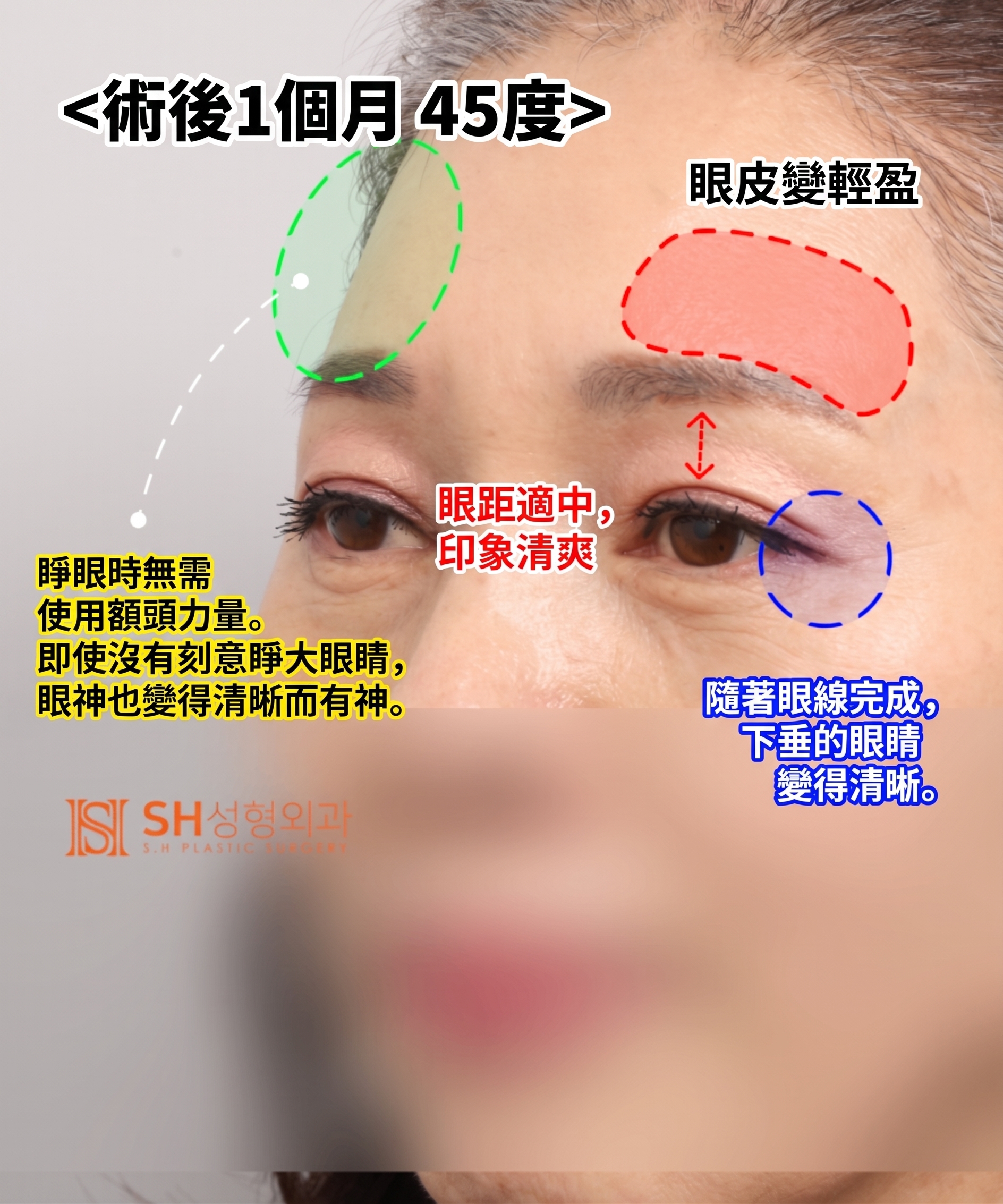 51歲眼皮下垂,為何選擇內視鏡五爪釘提眉術而非切開式雙眼皮? | 眉下提拉·下眼瞼複合手術案例 SH整形外科 사진 9