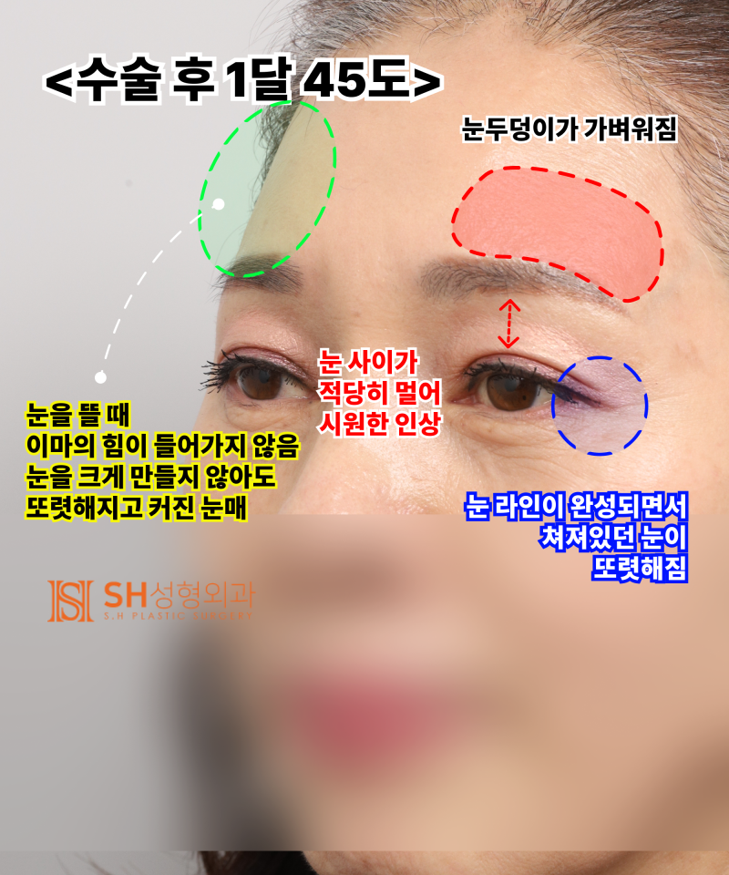 51세 눈처짐, 절개쌍꺼풀 대신 엔도타인 이마거상으로 해결한 이유 | 눈썹하거상·하안검 복합수술 케이스 SH성형외과 에스에이치성형외과 사진 9