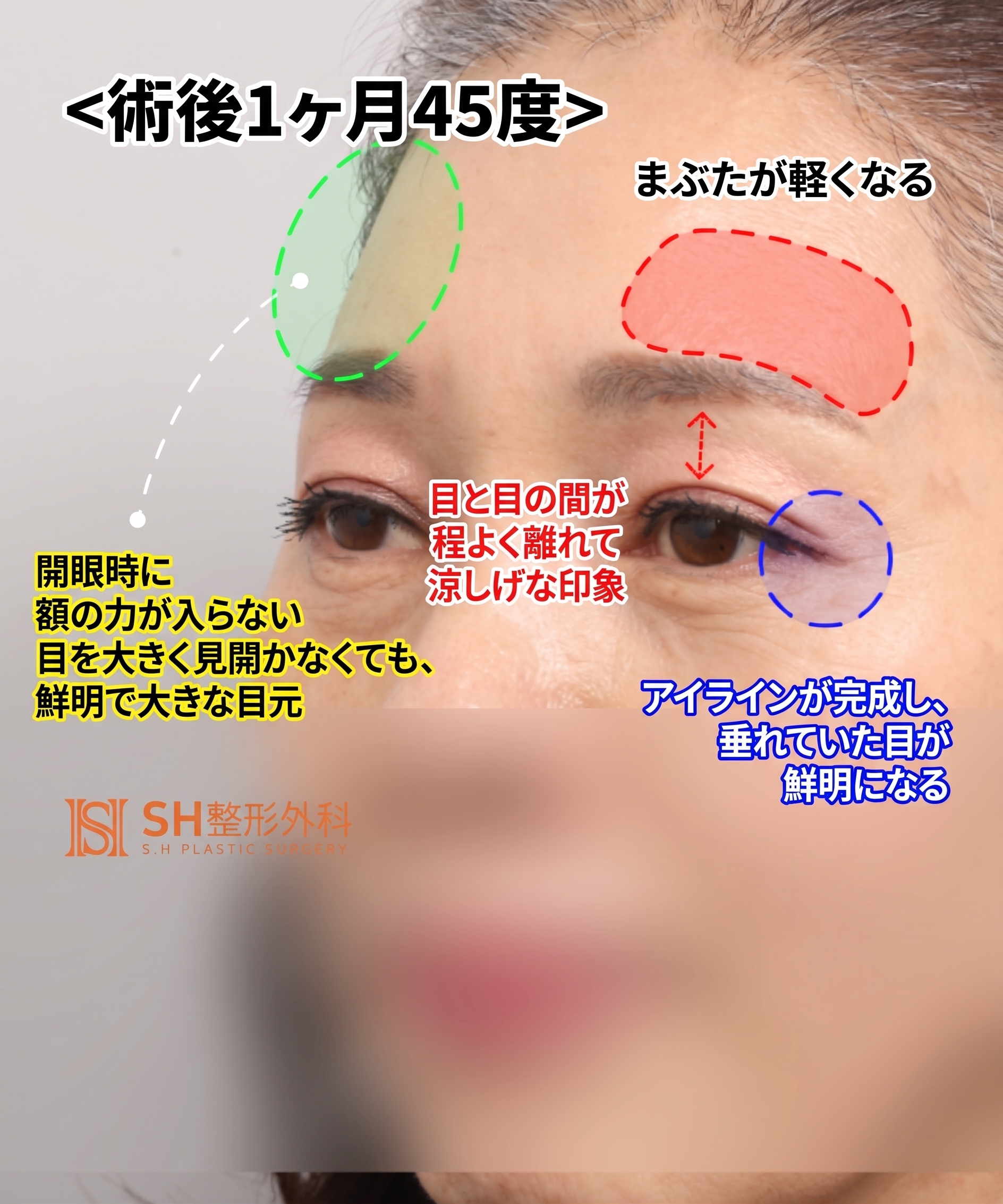51歳目のたるみ、切開二重ではなくエンドタイン額挙上で解決した理由 | 眉下切開・下眼瞼複合手術ケース SH美容外科 エスエイチ美容外科 사진 15