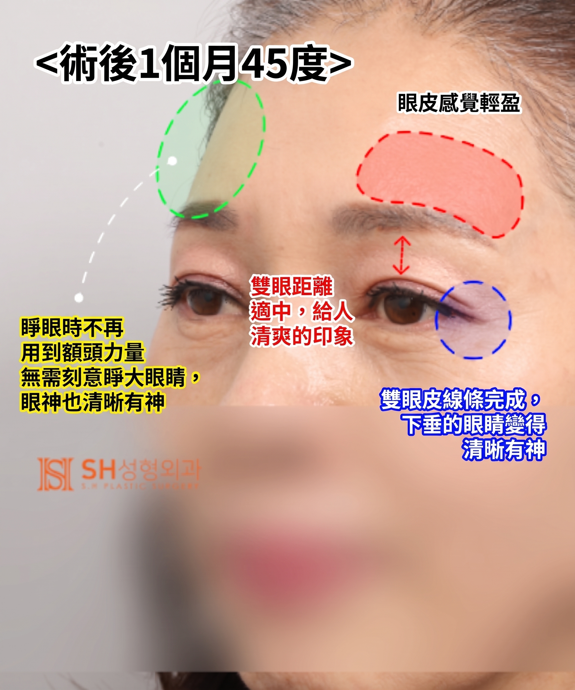 51歲眼皮下垂,為何選擇內視鏡五爪釘提眉術而非切開式雙眼皮? | 眉下提拉·下眼瞼複合手術案例 SH整形外科 사진 15