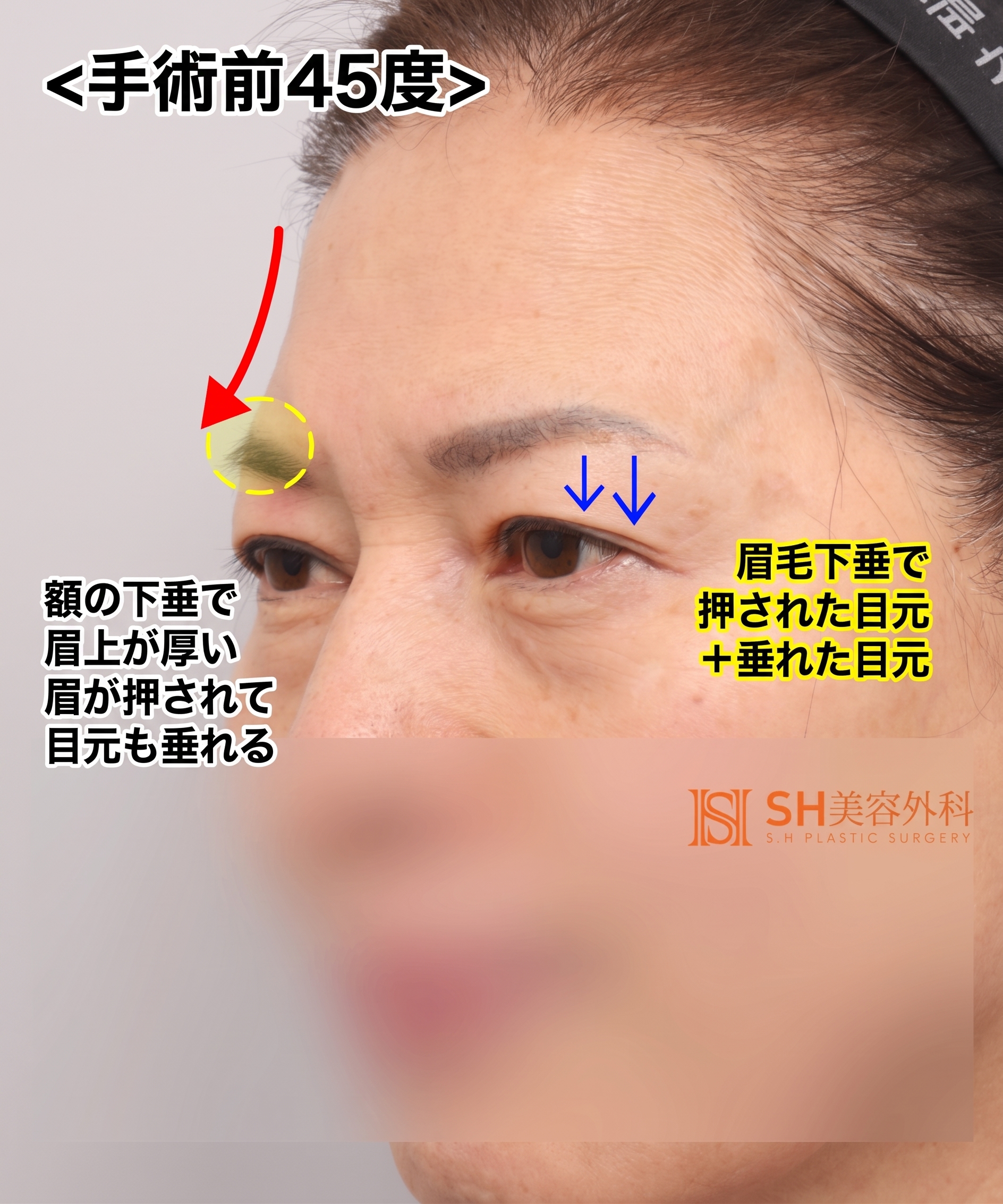 51歳目のたるみ、切開二重ではなくエンドタイン額挙上で解決した理由 | 眉下切開・下眼瞼複合手術ケース SH美容外科 エスエイチ美容外科 사진 4
