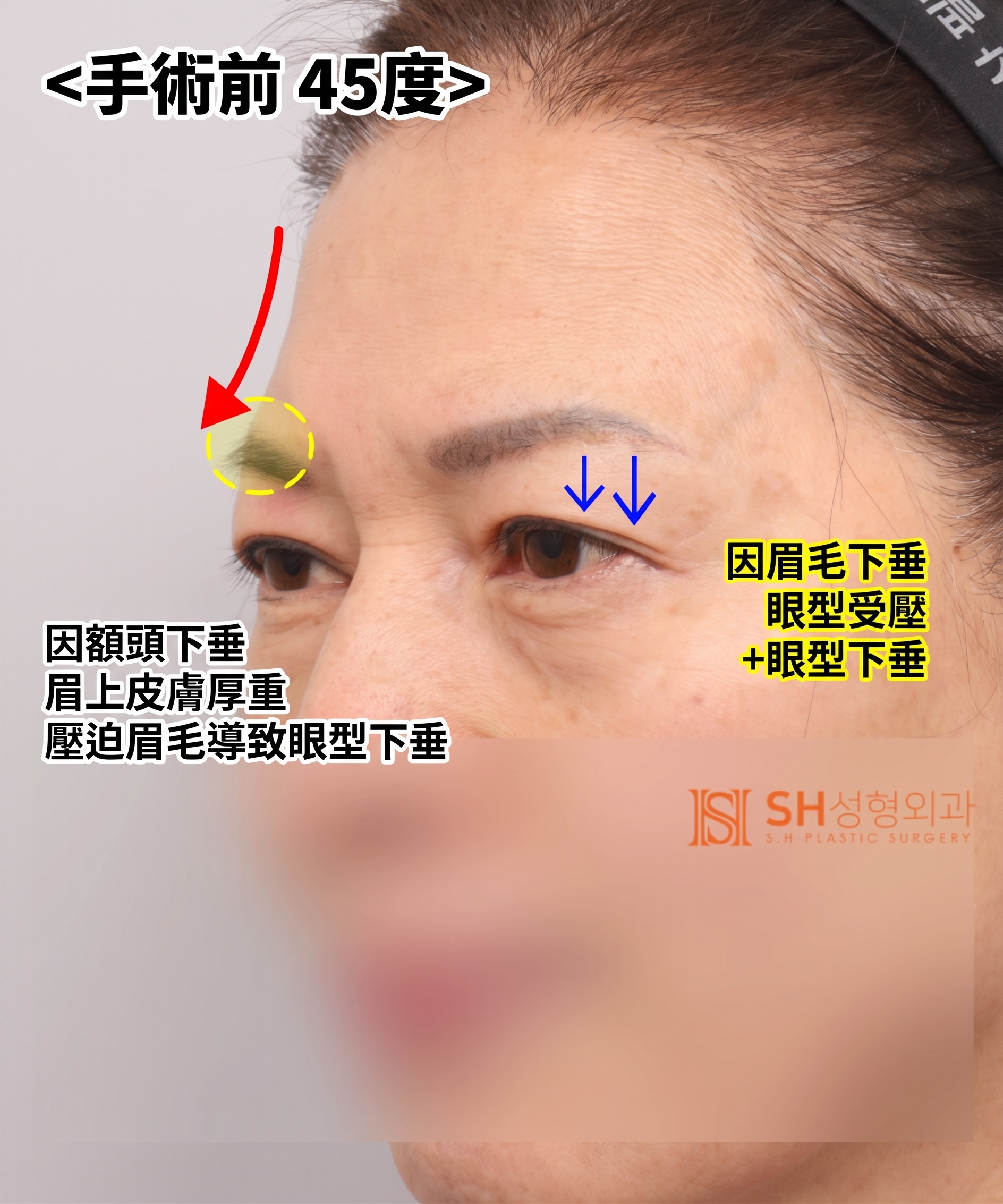 51歲眼皮下垂,為何選擇內視鏡五爪釘提眉術而非切開式雙眼皮? | 眉下提拉·下眼瞼複合手術案例 SH整形外科 사진 4