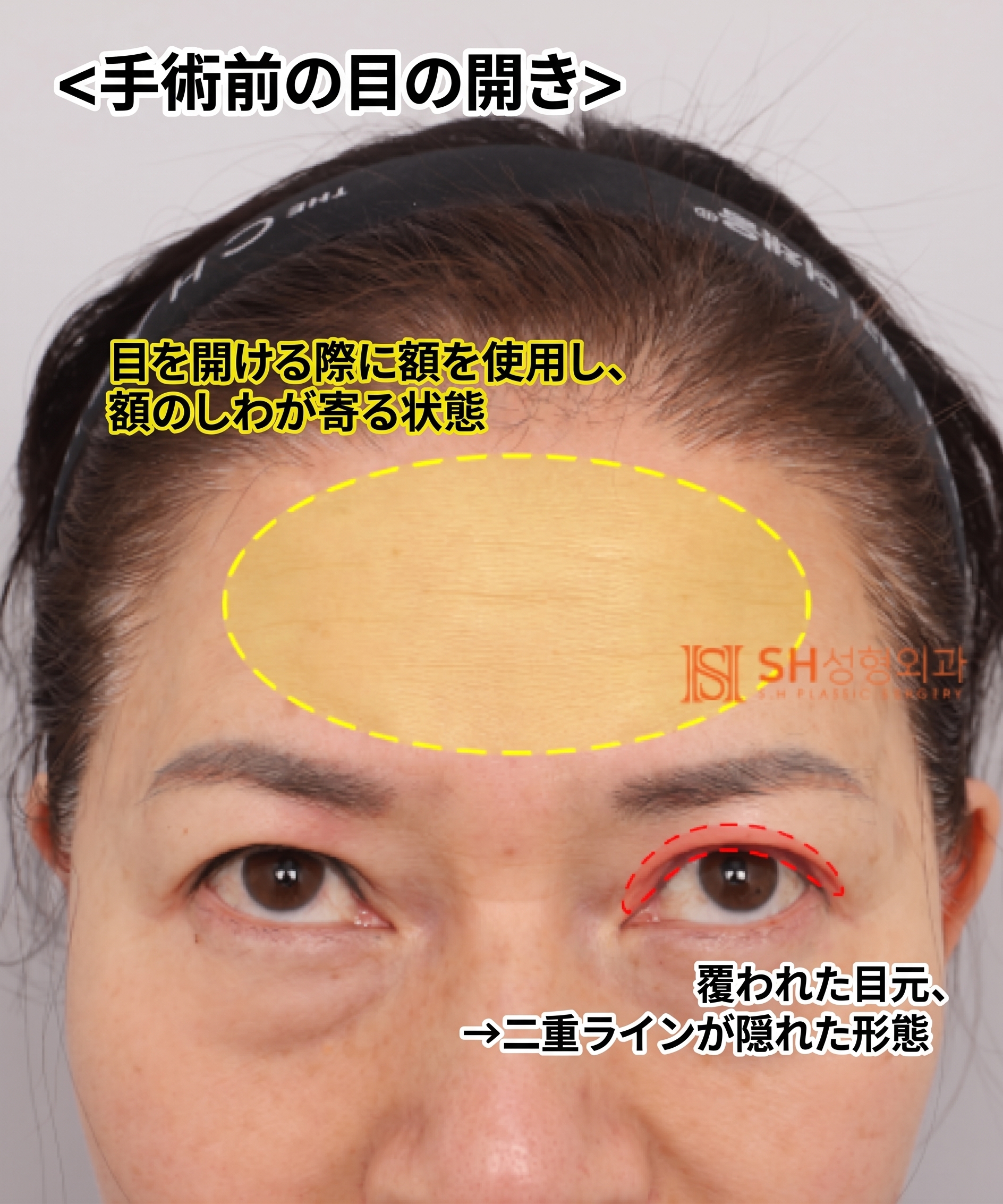 51歳目のたるみ、切開二重ではなくエンドタイン額挙上で解決した理由 | 眉下切開・下眼瞼複合手術ケース SH美容外科 エスエイチ美容外科 사진 10