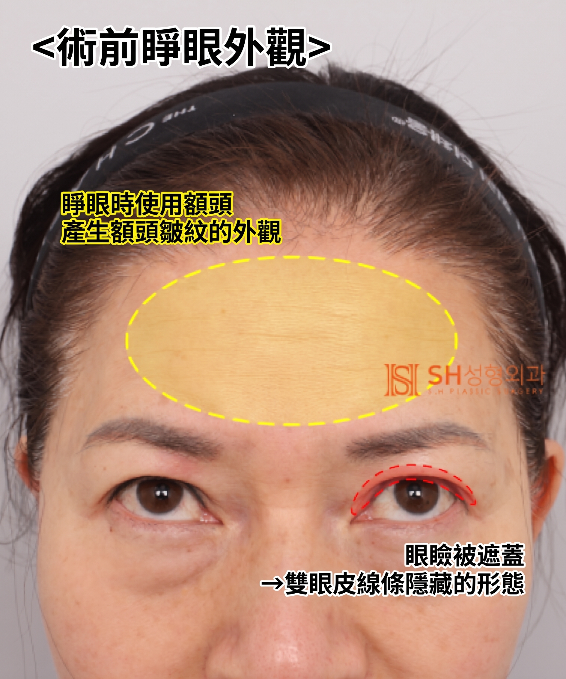 51歲眼皮下垂,為何選擇內視鏡五爪釘提眉術而非切開式雙眼皮? | 眉下提拉·下眼瞼複合手術案例 SH整形外科 사진 10