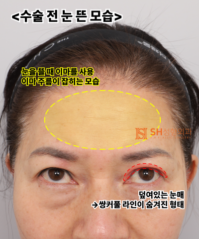 51세 눈처짐, 절개쌍꺼풀 대신 엔도타인 이마거상으로 해결한 이유 | 눈썹하거상·하안검 복합수술 케이스 SH성형외과 에스에이치성형외과 사진 10