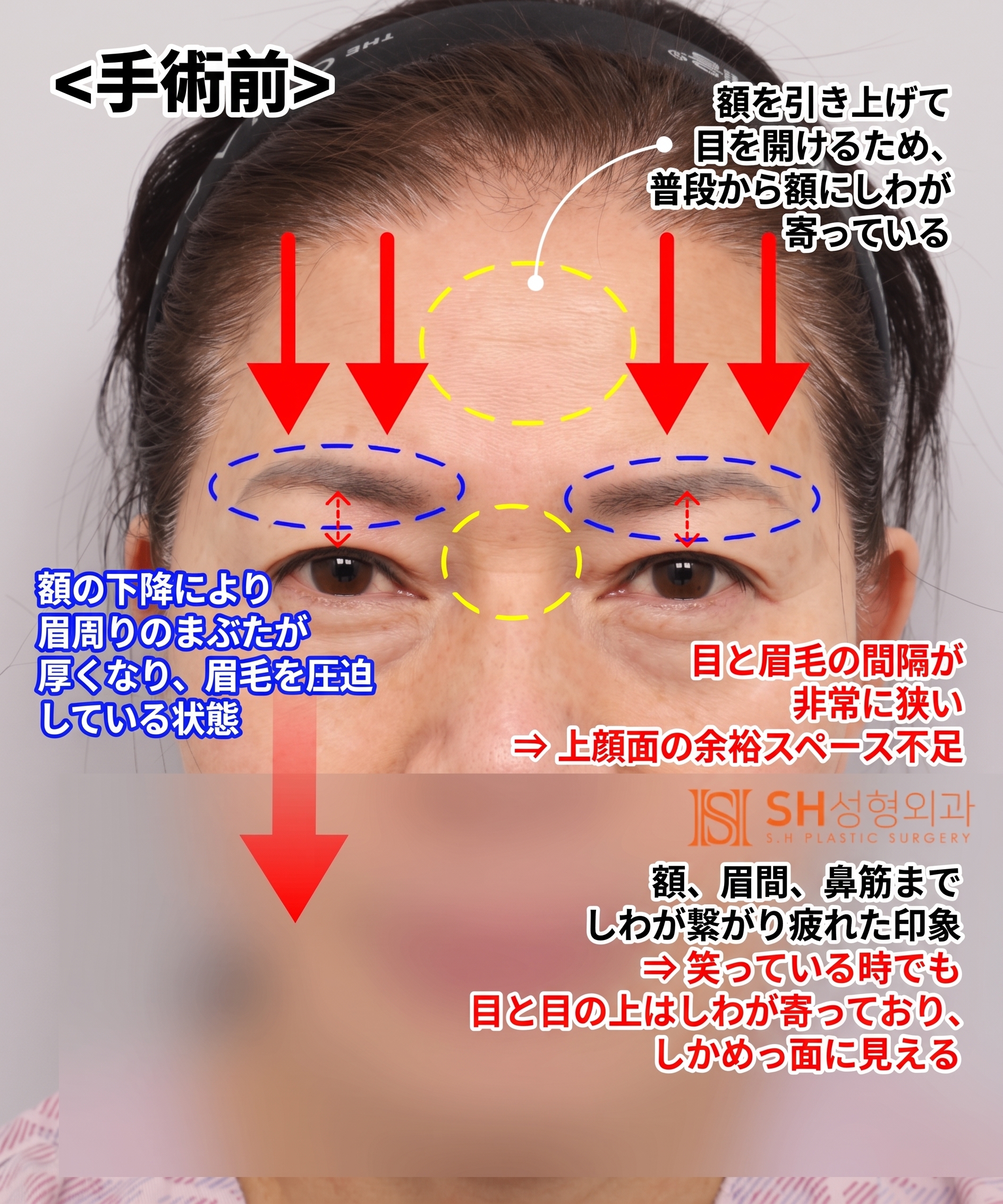 51歳目のたるみ、切開二重ではなくエンドタイン額挙上で解決した理由 | 眉下切開・下眼瞼複合手術ケース SH美容外科 エスエイチ美容外科 사진 3