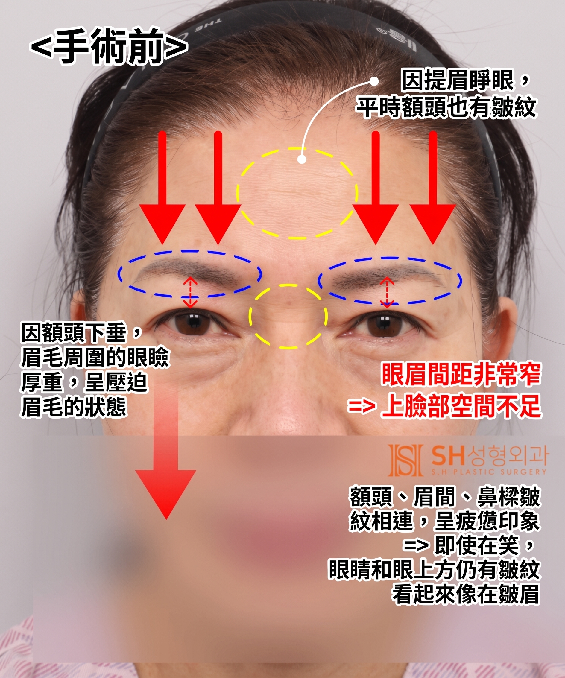 51歲眼皮下垂,為何選擇內視鏡五爪釘提眉術而非切開式雙眼皮? | 眉下提拉·下眼瞼複合手術案例 SH整形外科 사진 3