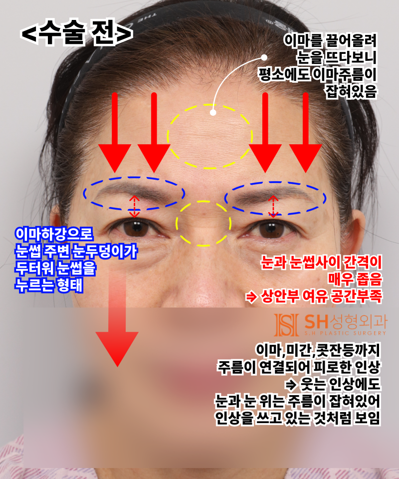 51세 눈처짐, 절개쌍꺼풀 대신 엔도타인 이마거상으로 해결한 이유 | 눈썹하거상·하안검 복합수술 케이스 SH성형외과 에스에이치성형외과 사진 3