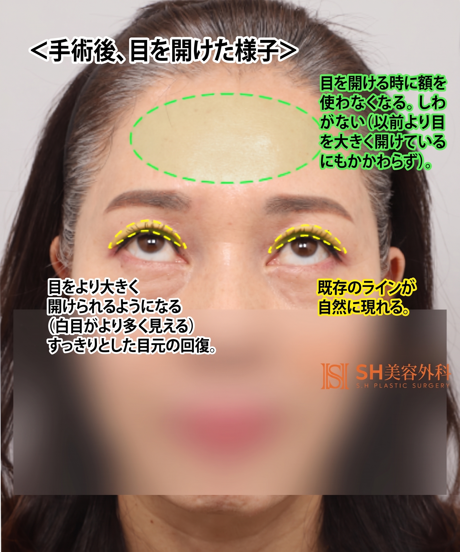 51歳目のたるみ、切開二重ではなくエンドタイン額挙上で解決した理由 | 眉下切開・下眼瞼複合手術ケース SH美容外科 エスエイチ美容外科 사진 11