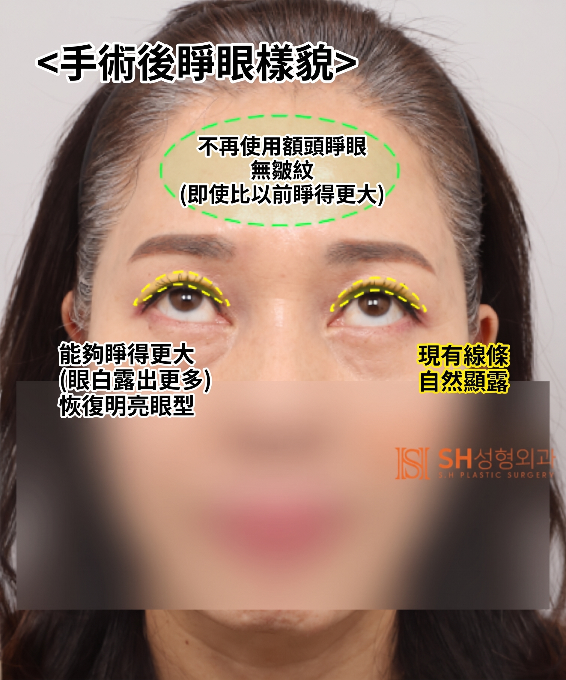 51歲眼皮下垂,為何選擇內視鏡五爪釘提眉術而非切開式雙眼皮? | 眉下提拉·下眼瞼複合手術案例 SH整形外科 사진 11