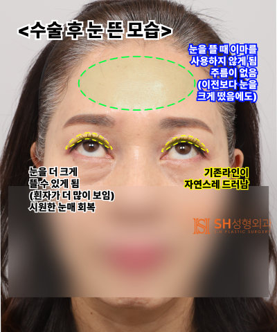 51세 눈처짐, 절개쌍꺼풀 대신 엔도타인 이마거상으로 해결한 이유 | 눈썹하거상·하안검 복합수술 케이스 SH성형외과 에스에이치성형외과 사진 11
