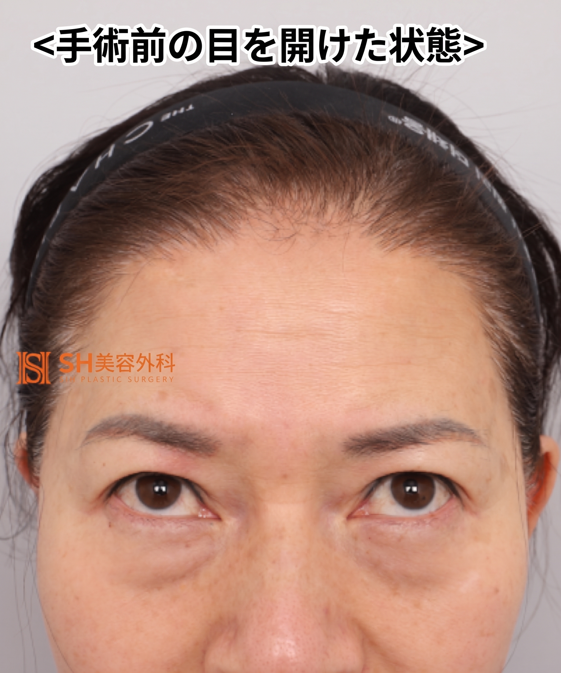 51歳目のたるみ、切開二重ではなくエンドタイン額挙上で解決した理由 | 眉下切開・下眼瞼複合手術ケース SH美容外科 エスエイチ美容外科 사진 12